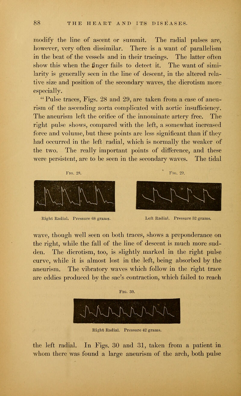 modify the line of ascent or summit. The radial pulses are, however, very often dissimilar. There is a want of parallelism in the beat of the vessels and in their tracings. The latter often show this when the finger fails to detect it. The want of simi- larity is generally seen in the line of descent, in the altered rela- tive size and position of the secondary waves, the dicrotism more especially.  Pulse traces, Figs. 28 and 29, are taken from a case of aneu- rism of the ascending aorta complicated with aortic insufficiency. The aneurism left the orifice of the innominate artery free. The right pulse shows, compared with the left, a somewhat increased force and volume, but these points are less significant than if they had occurred in the left radial, which is normally the weaker of the two. The really important points of difference, and these were persistent, are to be seen in the secondary waves. The tidal Fro. 2R. Right Radial. Pressure 68 grams. Fig. 29. Left Radial. Pressure 52 grams. wave, though well seen on both traces, shows a preponderance on the right, while the fall of the line of descent is much more sud- den. The dicrotism, too, is slightly marked in the right pulse curve, while it is almost lost in the left, being absorbed by the aneurism. The vibratory waves which follow in the right trace are eddies produced by the sac's contraction, which failed to reach Right Radial. Pressure 42 grams. the left radial. In Figs. 30 and 31, taken from a patient in whom there was found a large aneurism of the arch, both pulse