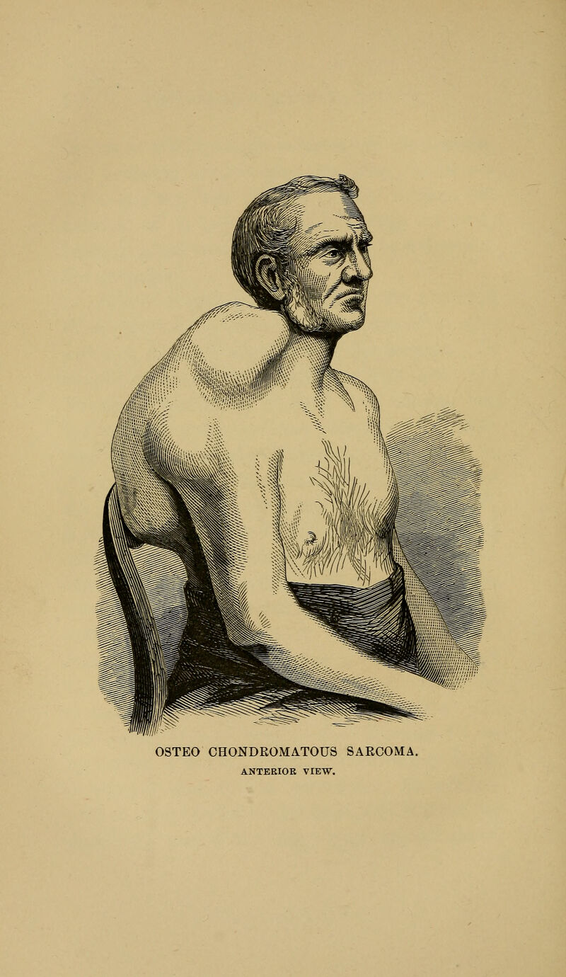 OSTEO OHONDROMATOUS SARCOMA. ANTBRIOK VIEW.