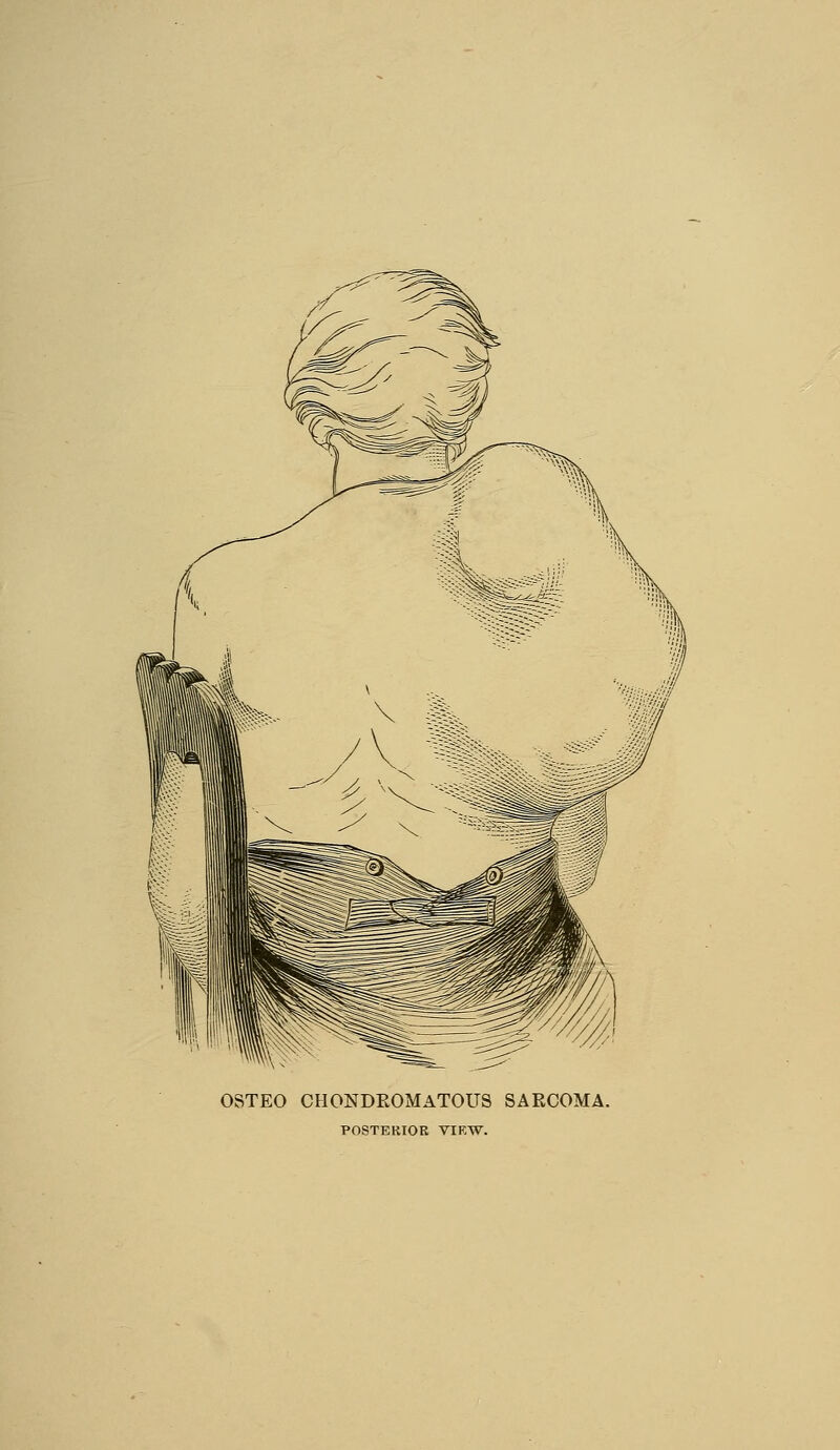 OSTEO CHONDEOMATOUS SARCOMA. POSTERIOR VIEW.