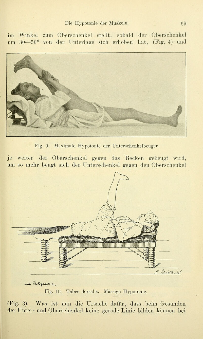 im Winkel zum Oberschenkel stellt, sobald der Oberscbenkel um 30—50° von der Unterlage sich erhoben hat, (Fig. 4) und Fig. 9. Maximale Hypotonie der ünterschenkelbeuger. je weiter der Oberschenkel gegen das Becken gebeugt wird, um so mehr beugt sich der Unterschenkel gegen den Oberschenkel w5^A/ Fig. 10. Tabes dorsalis. Massige Hypotonie. (Fig. 3). Was ist nun die Ursache dafür, dass beim Gesunden der Unter- und Oberschenkel keine gerade Linie bilden können bei