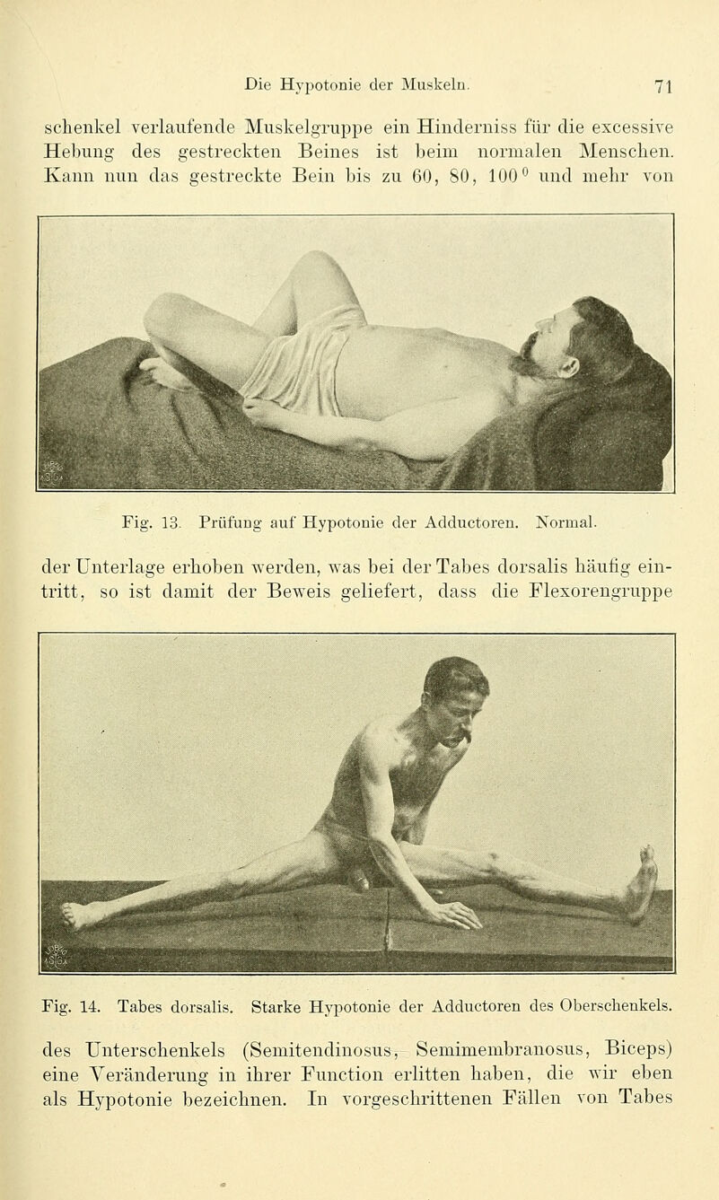 schenke! verlaufende Muskelgruppe ein Hinderniss für die excessive Hebung des gestreckten Beines ist beim normalen Menschen. Kann nun das gestreckte Bein bis zu 60, 80, 100° und mehr von Fig. 13. Prüfung auf Hypotonie der Adductoren. Normal. der Unterlage erhoben werden, was bei der Tabes dorsalis häufig ein- tritt, so ist damit der Beweis geliefert, dass die Flexorengruppe Fig. 14. Tabes dorsalis. Starke Hypotonie der Adductoren des Oberschenkels. des Unterschenkels (Semitendinosus, Semimembranosus, Biceps) eine Yeränderung in ihrer Function erlitten haben, die wir eben als Hypotonie bezeichnen. In vorgeschrittenen Fällen von Tabes