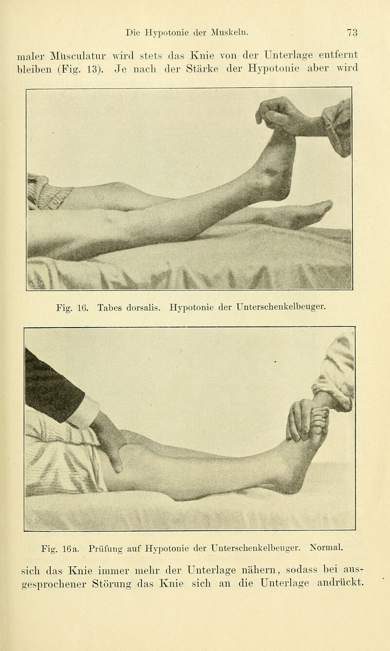 iiialer Miisciilatur wird stets das Knie von der Unterlage entfernt bleiben (Fig. 13). Je nach der Stärke der Hypotonie aber wird Fig. 16. Tabes dorsalis. Hypotonie der Unterschenkelbeuger. Fig. 16 a. Prüfung auf Hypotonie der Uuterscheukelbeuger. Normal. sich das Knie immer mehr der Unterlage nähern, sodass bei aus- gesprochener Störung das Knie sich an die Unterlage andrückt.