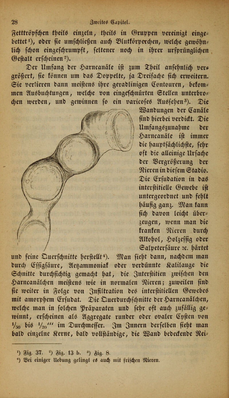 getttro^fc^en t^ette einzeln, tytiU in ©ru^en vereinigt einge* bettet1)/ ober fte umfdjtteßen aud) Sötutförperc^en, welche gewölnt' Ixc^> fcfyon eingefdjrumpft, feltener nodj in iljrer urfprüngttdjen ©eftatt erfd;einen2). ©er Umfang ber £arncanä(e ift jum £Jmt anfefmticf) *>er* gröfiert, fte fönnen um ba$ ©oppelte, ja ©reifadje ftcf> erweitern. (Sie vertieren bann metftenS ifjre gerabtinigen (Jontouren, klom- men 3tu3bud)tungen, welche tton eingefc^nürten Steifen unterbro* cfyen werben, unb gewinnen fo tin x>aricofe£ Sluöfeljen3). Sie Söanbungen ber Kanäle fi'nb hierbei tterbidt. £)te Umfang^unatnne ber £arneanäle ift immer bie fjauptfäcfyfidjfte, feljr oft bie alleinige Urfad;e ber Vergrößerung ber Vieren in biefem ©tabio. 2)ie @rfubation in ba$ interftitieße ©ewebe ift untergeorbnet unb feplt ^auftg ganj. Wlan fann jtcfy batton leicht über- zeugen, wenn man bie franfen Vieren burd) Süfofjol, £ol$efftg ober ©afyeterfäure :c. gärtet 5D?an fiept bann, naetybem man burd) ©fftgfäure, Sleßammoniaf ober serbünnte Kalilauge bie @d)nütt burcf)fid)tig gemad;t fjat, bie -Snterftttten jwtfd)en ben £arncancitd;en metftenS wie in normalen Vieren; juweiten finb fte weiter in golge son Infiltration be£ interftitiellen ©ewebe^ mit amor^em Srfubat. 25ie Ouerburd;fd)nitte ber^arncanäfd;en, we(d;e man in folgen Präparaten unb fepr oft aud; jufätlig ge* winnt, erfdjeinen aU Aggregate runber ober oraler (Soften t>on unb feine Duerfdjnitte Ijerftettt4). Vso M« V20' tm 2)ur$meffer. 3m Innern berfetben ftept man batb einzelne Äerne, batb t>ol(ftänbige, bie SBanb bebeefenbe dttu !) 8ifl. 37. 0 3iÄ. 13 b. 3) gifl. 8. 4) $3ei einiger Hebung gelingt c$ aud) mit frifdjett Vieren.