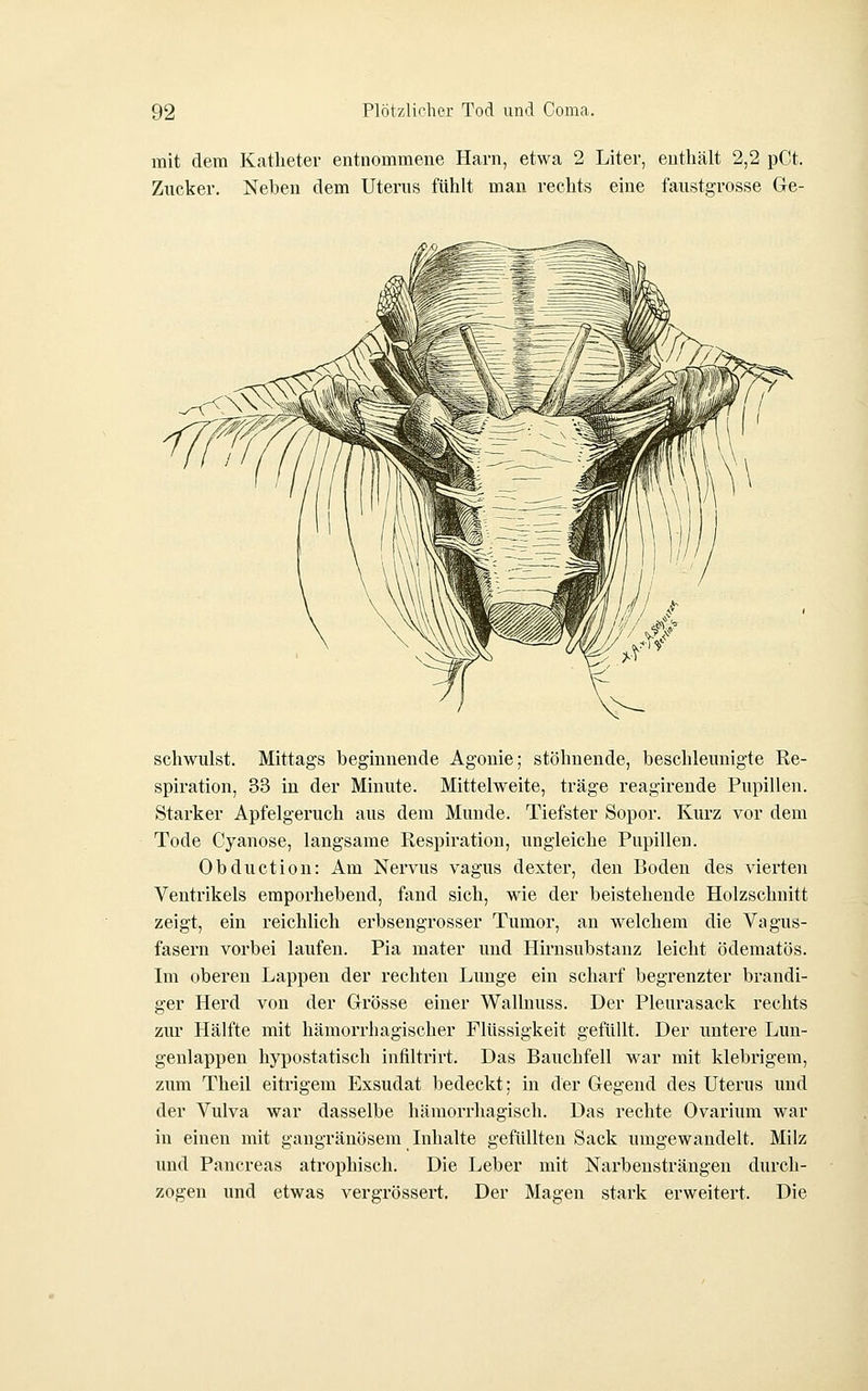 mit dem Katheter entnommene Harn, etwa 2 Liter, enthält 2,2 pCt. Zucker. Neben dem Uterus fühlt man rechts eine faustgrosse Ge- schwulst. Mittags beginnende Agonie; stöhnende, beschleunigte Re- spiration, 33 in der Minute. Mittelweite, träge reagirende Pupillen. Starker Apfelgeruch aus dem Munde. Tiefster Sopor. Kurz vor dem Tode Cyanose, langsame Respiration, ungleiche Pnpillen. Obduction: Am Nervus vagus dexter, den Boden des vierten Ventrikels emporhebend, fand sich, wie der beistehende Holzschnitt zeigt, ein reichlich erbsengrosser Tumor, an welchem die Vagus- fasern vorbei laufen. Pia mater und Hirnsubstanz leicht ödematös. Im oberen Lappen der rechten Lunge ein scharf begrenzter brandi- ger Herd von der Grösse einer Wallnuss. Der Pleurasack rechts zur Hälfte mit hämorrhagischer Flüssigkeit gefüllt. Der untere Lun- genlappen hypostatisch infiltrii't. Das Bauchfell war mit klebrigem, zum Theil eitrigem Exsudat bedeckt; in der Gegend des Uterus und der Vulva war dasselbe hämorrhagisch. Das rechte Ovarium war in einen mit gangränösem Lihalte gefüllten Sack umgewandelt. Milz und Pancreas atrophisch. Die Leber mit Narbensträngen durch- zogen und etwas vergrössert. Der Magen stark erweitert. Die