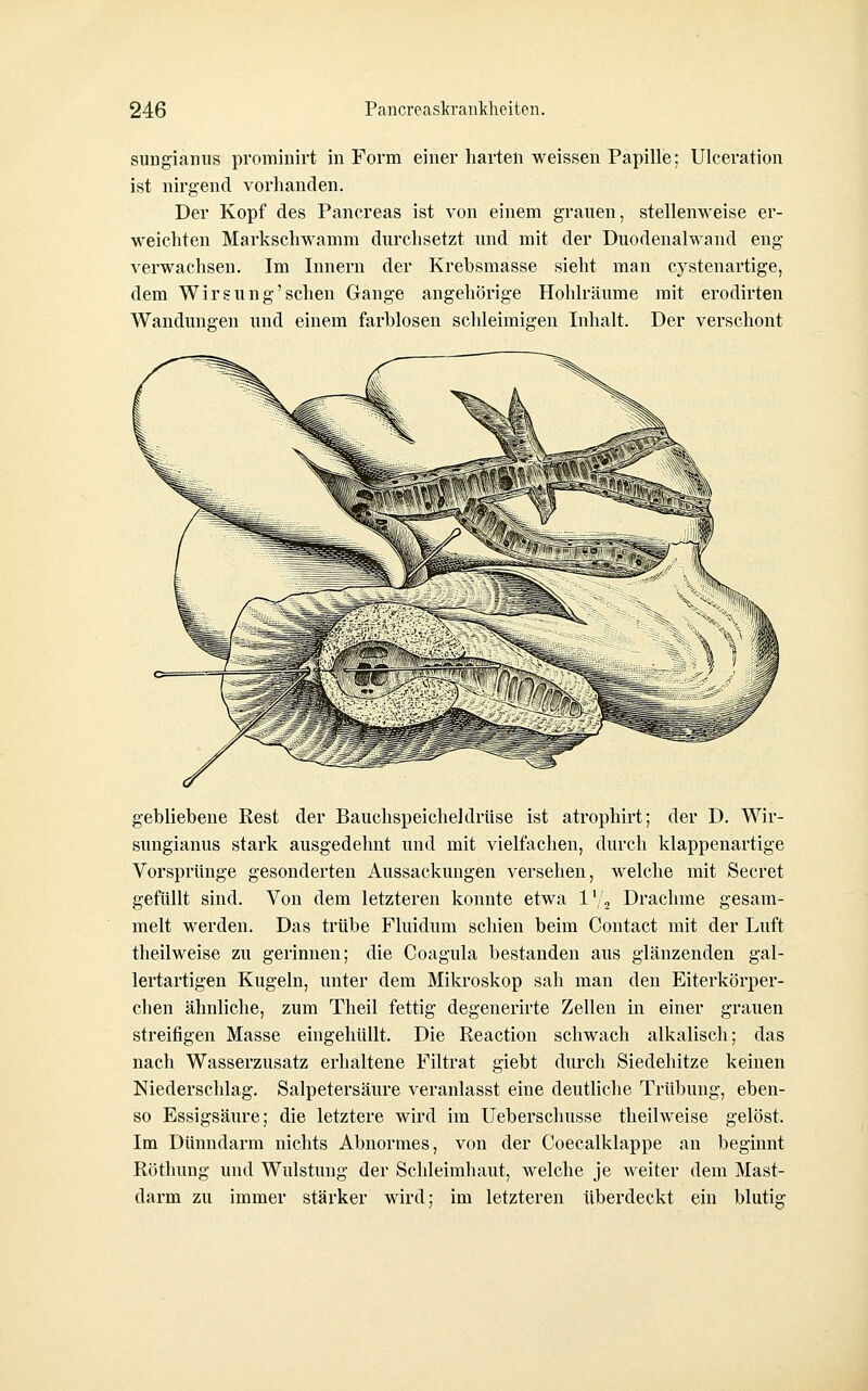 sungianus prominirt in Form einer harten weissen Papille; Ulceration ist nirgend vorhanden. Der Kopf des Pancreas ist von einem grauen, stellenweise er- weichten Markschwamm durchsetzt und mit der Duodenalwand eng verwachsen. Im Innern der Krebsmasse sieht man cystenartige, dem Wirsung'sehen Gange angehörige Plohlräume mit erodirten Wandungen und einem farblosen schleimigen Inhalt. Der verschont gebliebene Rest der Bauchspeicheldrüse ist atrophirt; der D. Wir- sungianus stark ausgedehnt und mit vielfachen, durch klappenartige Vorsprünge gesonderten Aussackungen versehen, welche mit Secret gefüllt sind. Von dem letzteren konnte etwa l'/^ Drachme gesam- melt werden. Das trübe Fluidum schien beim Contact mit der Luft theilweise zu gerinnen; die Coagula bestanden aus glänzenden gal- lertartigen Kugeln, unter dem Mikroskop sah man den Eiterkörper- chen ähnliche, zum Theil fettig degenerirte Zellen in einer grauen streifigen Masse eingehüllt. Die Reaction schwach alkalisch; das nach Wasserzusatz erhaltene Filtrat giebt durch Siedehitze keinen Niederschlag. Salpetersäure veranlasst eine deutliche Trübung, eben- so Essigsäure; die letztere wird im Ueberschusse theilweise gelöst. Im Dünndarm nichts Abnormes, von der Coecalklappe an begmnt Röthung und Wulstung der Schleimhaut, welche je weiter dem Mast- darm zu immer stärker wird; im letzteren überdeckt ein blutig