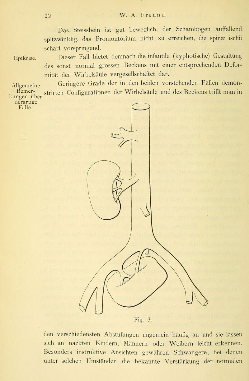 Epikrise. Das Steissbein ist gut beweglich, der Schambogen auffallend spitzwinklig, das Promontorium nicht zu erreichen, die Spinae ischii scharf vorspringend. Dieser Fall bietet demnach die infantile (kyphotische) Gestaltung des sonst normal grossen Beckens mit einer entsprechenden Defor- mität der Wirbelsäule vergesellschaftet dar. Allgemeine Geringere Grade der in den beiden vorstehenden Fällen demon- Bemer- strirten Configurationen der Wirbelsäule und des Beckens trifft man in kungen über derartige Fälle. den verschiedensten Abstufungen ungemein häufig an und sie lassen sich an nackten Kindern, Männern oder Weibern leicht erkennen. Besonders instruktive Ansichten gewähren Schwangere, bei denen unter solchen Umständen die bekannte Verstärkung der normalen