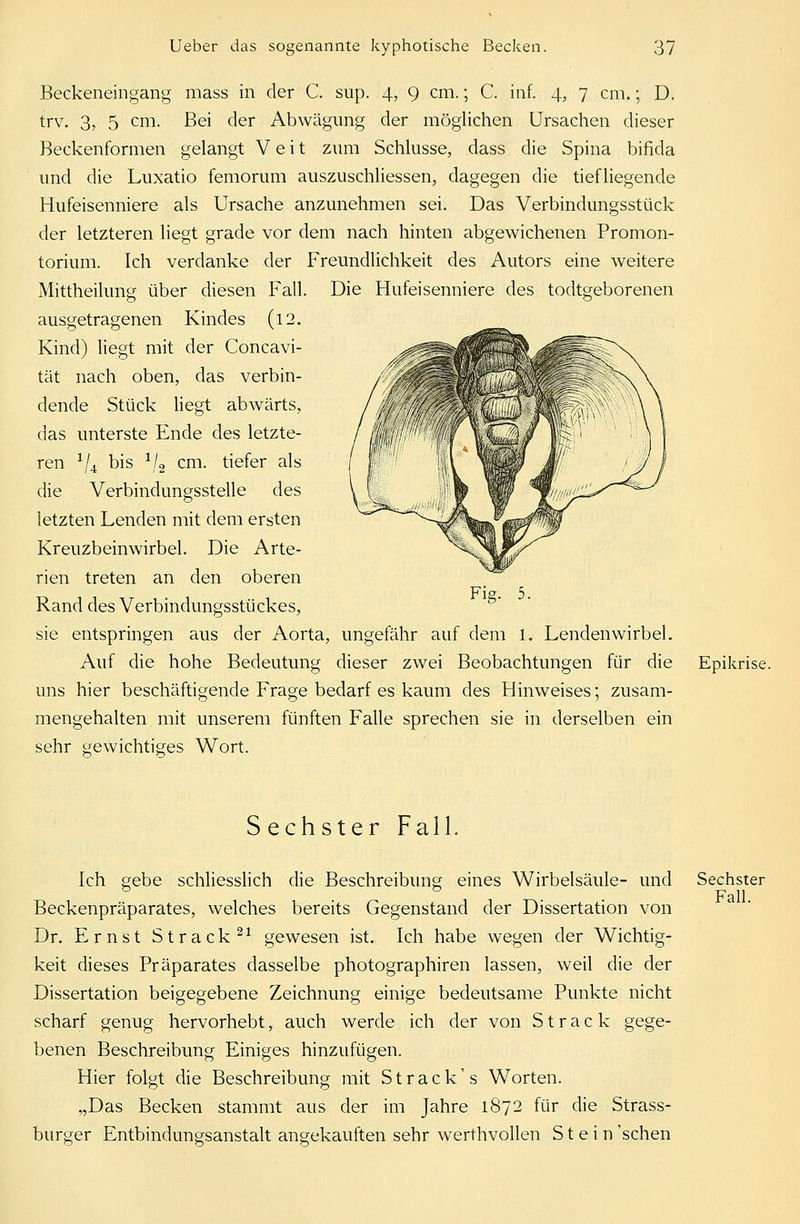 Beckeneingang mass in der C. sup. 4, 9 cm.; C. inf. 4, 7 cm.; D. trv. 3, 5 cm. Bei der Abwägung der möglichen Ursachen dieser Beckenformen gelangt Veit zum Schlüsse, dass die Spina bifida und die Luxatio femorum auszuschliessen, dagegen die tiefliegende Hufeisenniere als Ursache anzunehmen sei. Das Verbindungsstück der letzteren liegt grade vor dem nach hinten abgewichenen Promon- torium. Ich verdanke der Freundlichkeit des Autors eine weitere Mittheilung über diesen Fall ausgetragenen Kindes (12. Kind) liegt mit der Concavi- tät nach oben, das verbin- dende Stück liegt abwärts, das unterste Ende des letzte- Die Hufeisenniere des todtgeborenen Fig. 5. ren x/4 bis 1/2 cm. tiefer als die Verbindungsstelle des letzten Lenden mit dem ersten Kreuzbeinwirbel. Die Arte- rien treten an den oberen Rand des Verbindungsstückes, sie entspringen aus der Aorta, ungefähr auf dem 1. Lendenwirbel. Auf die hohe Bedeutung dieser zwei Beobachtungen für die uns hier beschäftigende Frage bedarf es kaum des Hinweises; zusam- mengehalten mit unserem fünften Falle sprechen sie in derselben ein sehr gewichtiges Wort. Epikrise. Sechster Fall. Ich gebe schliesslich die Beschreibung eines Wirbelsäule- und Beckenpräparates, welches bereits Gegenstand der Dissertation von Dr. Ernst Strack21 gewesen ist. Ich habe wegen der Wichtig- keit dieses Präparates dasselbe photographiren lassen, weil die der Dissertation beigegebene Zeichnung einige bedeutsame Punkte nicht scharf genug hervorhebt, auch werde ich der von Strack gege- benen Beschreibung Einiges hinzufügen. Hier folgt die Beschreibung mit Strack's Worten. „Das Becken stammt aus der im Jahre 1872 für die Strass- burger Entbindungsanstalt angekauften sehr werthvollen Stein 'sehen Sechster Fall.