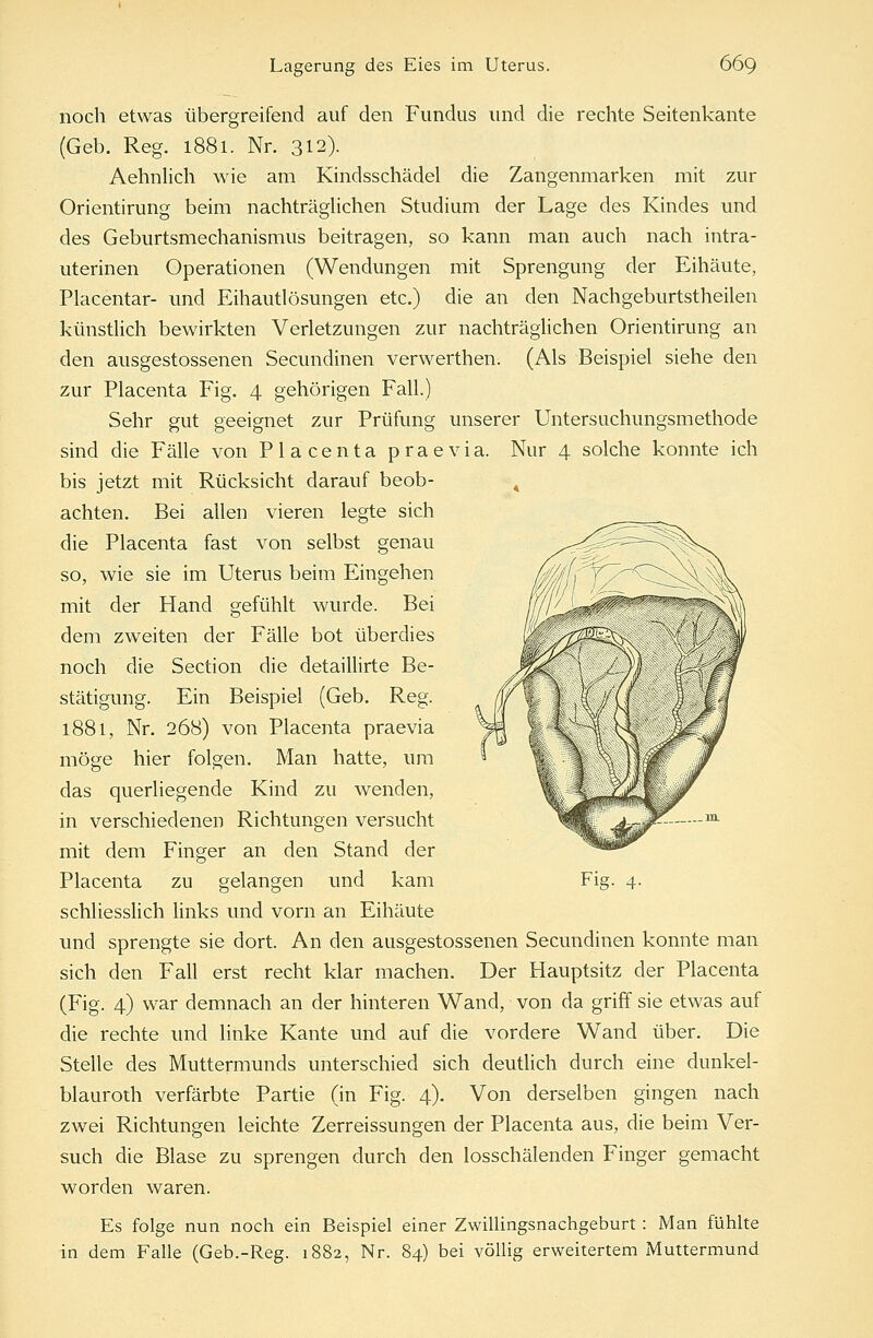 noch etwas übergreifend auf den Fundus und die rechte Seitenkante (Geb. Reg. 1881. Nr. 312). Aehnlich wie am Kindsschädel die Zangenmarken mit zur Orientirung beim nachträglichen Studium der Lage des Kindes und des Geburtsmechanismus beitragen, so kann man auch nach intra- uterinen Operationen (Wendungen mit Sprengung der Eihäute, Placentar- und Eihautlösungen etc.) die an den Nachgeburtstheilen künstlich bewirkten Verletzungen zur nachträglichen Orientirung an den ausgestossenen Secundinen verwerthen. (Als Beispiel siehe den zur Placenta Fig. 4 gehörigen Fall.) Sehr gut geeignet zur Prüfung unserer Untersuchungsmethode sind die Fälle von Placenta praevia. Nur 4 solche konnte ich bis jetzt mit Rücksicht darauf beob- achten. Bei allen vieren legte sich die Placenta fast von selbst genau so, wie sie im Uterus beim Eingehen mit der Hand gefühlt wurde. Bei dem zweiten der Fälle bot überdies noch die Section die detaillirte Be- stätigung. Ein Beispiel (Geb. Reg. 1881, Nr. 268) von Placenta praevia möge hier folgen. Man hatte, um das querliegende Kind zu wenden, in verschiedenen Richtungen versucht mit dem Finger an den Stand der schliesslich links und vorn an Eihäute und sprengte sie dort. An den ausgestossenen Secundinen konnte man sich den Fall erst recht klar machen. Der Hauptsitz der Placenta (Fig. 4) war demnach an der hinteren Wand, von da griff sie etwas auf die rechte und linke Kante und auf die vordere Wand über. Die Stelle des Muttermunds unterschied sich deutlich durch eine dunkel- blauroth verfärbte Partie (in Fig. 4). Von derselben gingen nach zwei Richtungen leichte Zerreissungen der Placenta aus, die beim Ver- such die Blase zu sprengen durch den losschälenden Finger gemacht worden waren. Es folge nun noch ein Beispiel einer Zwillingsnachgeburt: Man fühlte in dem Falle (Geb.-Reg. 1882, Nr. 84) bei völlig erweitertem Muttermund