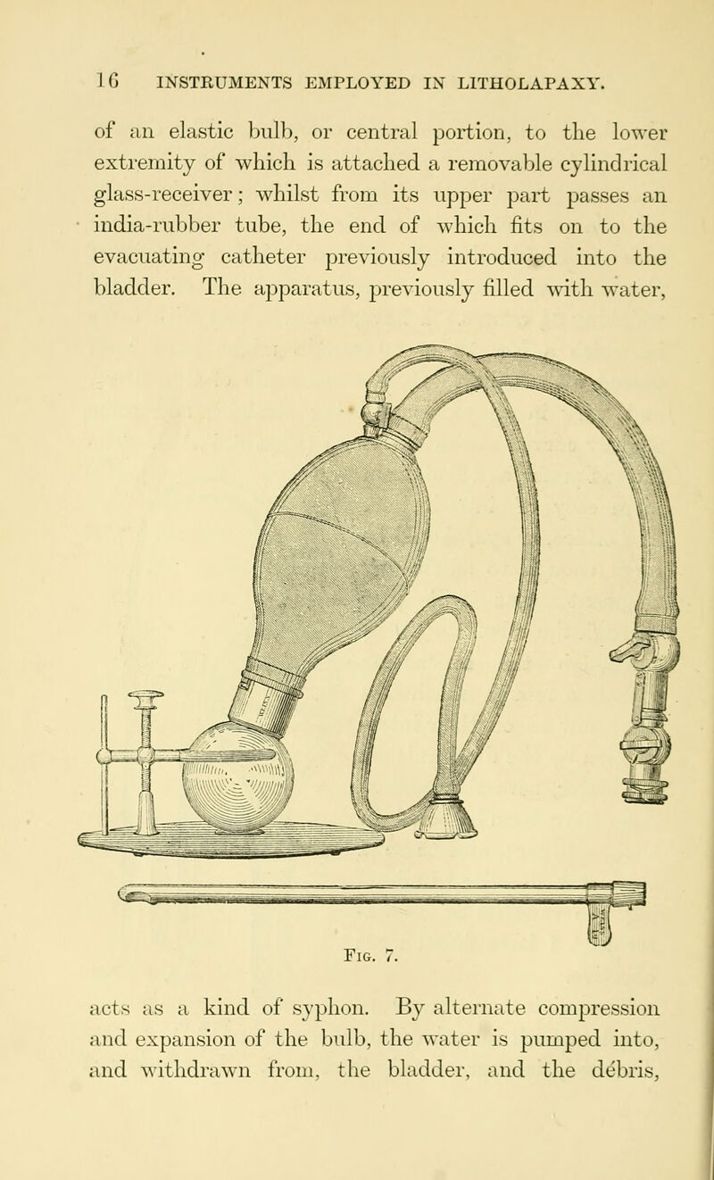 of an elastic bulb, or central portion, to the lower extremity of which is attached a removable cylindrical glass-receiver; whilst from its upper part passes an india-rubber tube, the end of which fits on to the evacuating catheter previously introduced into the bladder. The apparatus, previously filled with water, acts as a kind of syphon. By alternate compression and expansion of the bulb, the water is pumped into, and withdrawn from, the bladder, and the debris,