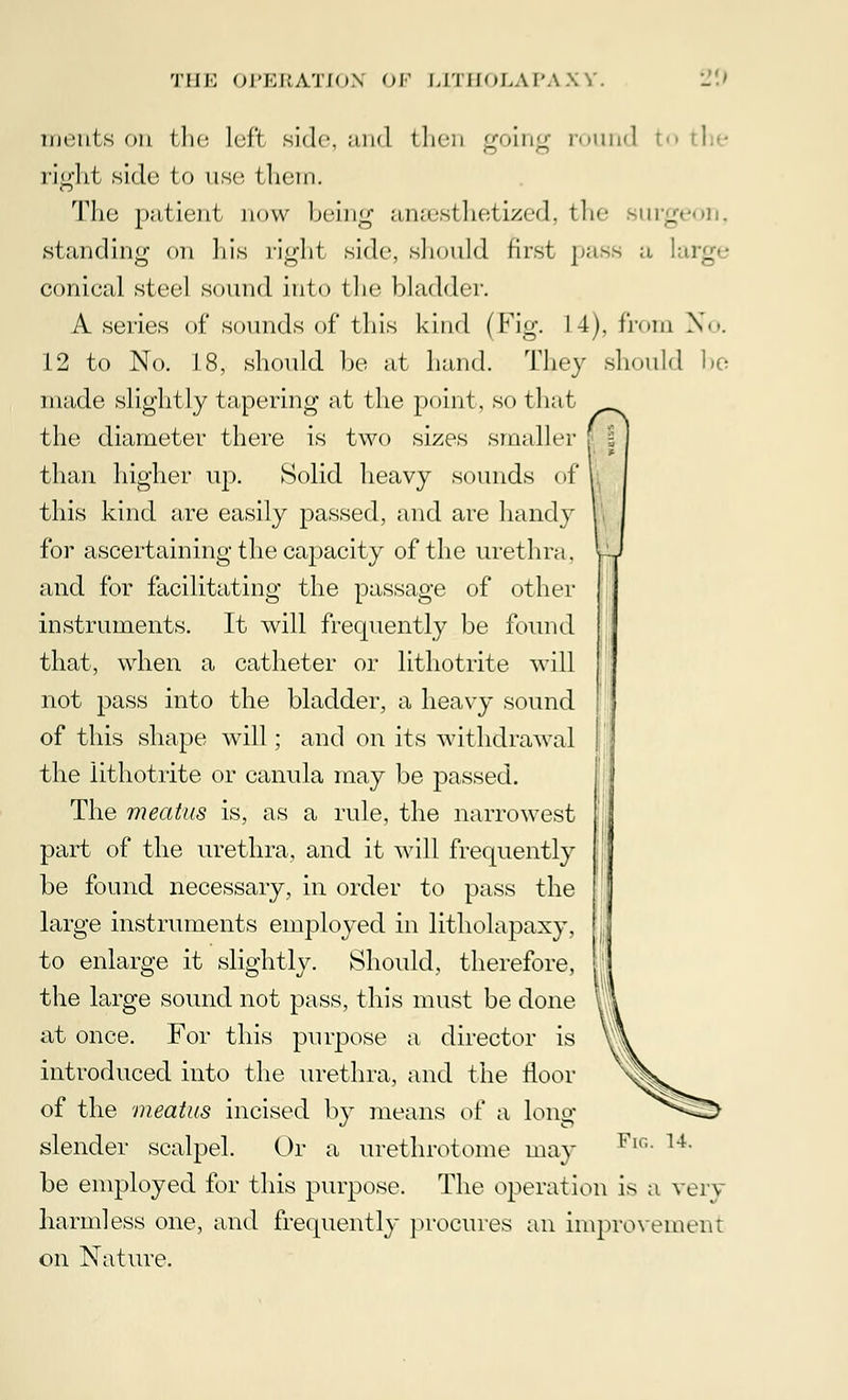 merits on the left side, and then Efoing round t< right side to use them. The patient now being anaesthetized, the standing on his right side, should first pass a !• _ conical steel sound into the bladder. A series of sounds of this kind (Fig. 14). from No. 12 to No. 18, should bo at hand. Thoy should be made slightly tapering at the point, so that the diameter there is two sizes smaller than higher up. Solid heavy sounds of this kind are easily passed, and are handy for ascertaining the capacity of the urethra. and for facilitating the passage of other instruments. It will frequently be found that, when a catheter or lithotrite will not pass into the bladder, a heavy sound of this shape will; and on its withdrawal the lithotrite or canula may be passed. The meatus is, as a rule, the narrowest part of the urethra, and it will frequently be found necessary, in order to pass the large instruments employed in litholapaxy, to enlarge it slightly. Should, therefore, the large sound not pass, this must be done at once. For this purpose a director is introduced into the urethra, and the floor of the meatus incised by means of a long slender scalpel. Or a urethrotome may be employed for this purpose. The operation is a very harmless one, and frequently procures an improvement on Nature. Fig. 14.