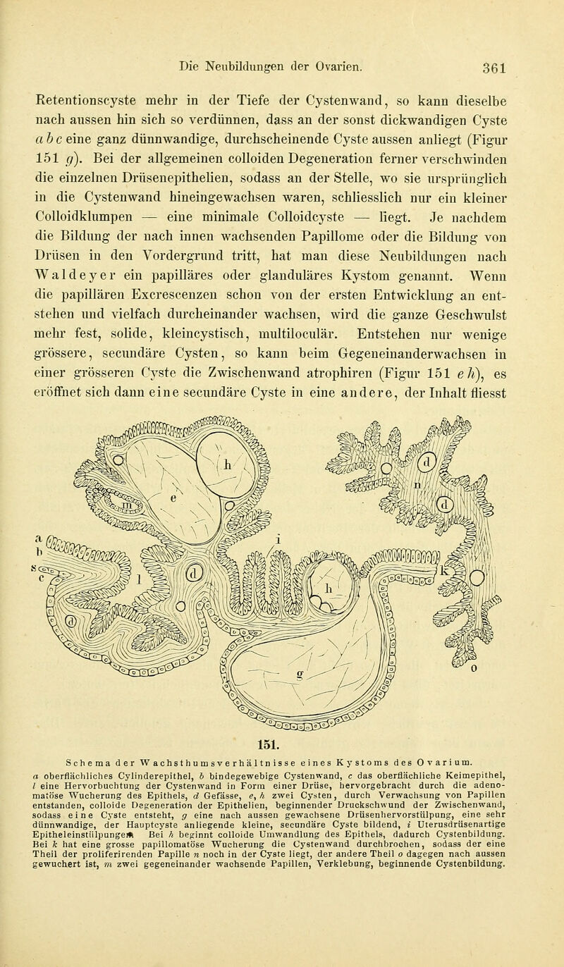 Retentionscyste mehr in der Tiefe der Cystenwand, so kann dieselbe nach aussen hin sich so verdünnen, dass an der sonst dickwandigen Cyste abc eine ganz dünnwandige, durchscheinende Cyste aussen anliegt (Figur 151 g). Bei der allgemeinen colloiden Degeneration ferner verschwinden die einzelnen Drüsenepithelien, sodass an der Stelle, wo sie ursprünglich in die Cystenwand hineingewachsen waren, schliesslich nur ein kleiner Colloidklumpen — eine minimale Colloidcyste — liegt. Je nachdem die Bildung der nach innen wachsenden Papillome oder die Bildung von Drüsen in den Vordergrund tritt, hat man diese Neubildungen nach Waldeyer ein papilläres oder glanduläres Kystom genannt. Wenn die papillären Excrescenzen schon von der ersten Entwicklung an ent- stehen und vielfach durcheinander wachsen, wird die ganze Geschwulst mehr fest, solide, kleincystisch, multiloculär. Entstehen nur wenige grössere, secundäre Cysten, so kann beim Gegeneinanderwachsen in einer grösseren Cyste die Zwischenwand atrophiren (Figur 151 eh), es eröffnet sich dann eine secundäre Cyste in eine andere, der Inhalt fliesst Schema der Wachsthumsverhältnisse eines Kystoms des Ovarium. a oberflächliches Cylinderepithel, b bindegewebige Cystenwand, c das oberflächliche Keimepithel, l eine Hervorbuchtung der Cystenwand in Form einer Drüse, hervorgebracht durch die adeno- matöse Wucherung des Epithels, d Gefässe, <?, h zwei Cysten, durch Verwachsung von Papillen entstanden, colloide Degeneration der Epithelien, beginnender Druckschwund der Zwischenwand, sodass eine Cyste entsteht, g eine nach aussen gewachsene Drüsenhervorstülpung, eine sehr dünnwandige, der Hauptcyste anliegende kleine, secundäre Cyste bildend, i Uterusdrüsenartige Epitheleinstülpunge* Bei h beginnt colloide Umwandlung des Epithels, dadurch Cystenbildung. Bei k hat eine grosse papillomatöse Wucherung die Cystenwand durchbrochen, sodass der eine Theil der proliferirenden Papille n noch in der Cyste liegt, der andere Theil o dagegen nach aussen gewuchert ist, m zwei gegeneinander wachsende Papillen, Verklebung, beginnende Cystenbildung.