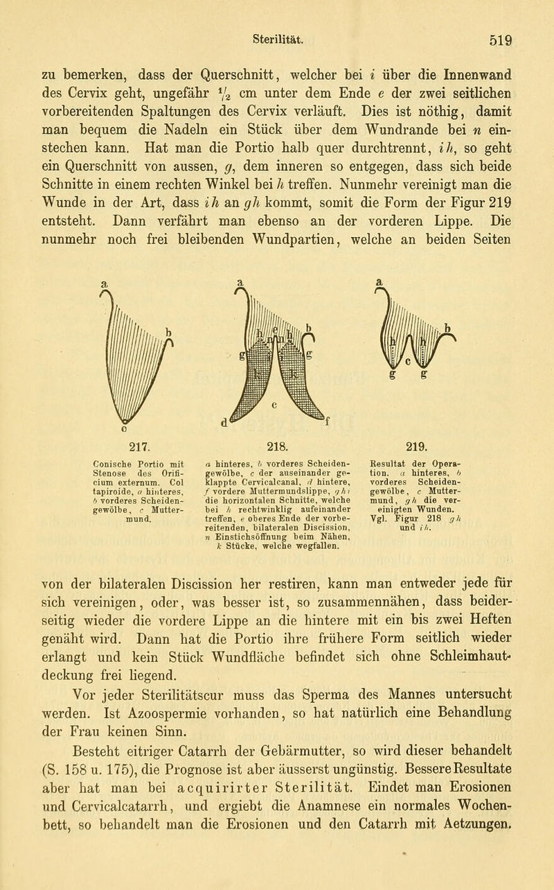 zu bemerken, dass der Querschnitt, welcher bei i über die Innenwand des Cervix geht, ungefähr Yg cm unter dem Ende e der zwei seitlichen vorbereitenden Spaltungen des Cervix verläuft. Dies ist nöthig, damit man bequem die Nadeln ein Stück über dem Wundrande bei n ein- stechen kann. Hat man die Portio halb quer durchtrennt, ih, so geht ein Querschnitt von aussen, g, dem inneren so entgegen, dass sich beide Schnitte in einem rechten Winkel bei h treffen. Nunmehr vereinigt man die Wunde in der Art, dass iJi an gh kommt, somit die Form der Figur 219 entsteht. Dann verfährt man ebenso an der vorderen Lippe. Die nunmehr noch frei bleibenden Wundpartien, welche an beiden Seiten 217. Conische Portio mit Stenose des Orifi- cium externum. Col tapiroide, a hinteres, f) vorderes Scheiden- e, c Mutter- mund. 218. a hinteres, '» vorderes Scheiden- gewölbe, c der auseinander ge- klappte Cervicalcanal, d hintere, /vordere Muttermundslippe, 'f/ii die horizontalen Schnitte, welche hei // rechtwinklig aufeinander treffen, e oberes Ende der vorbe- reitenden, bilateralen Discission, n Einstichsöffnung beim Nähen, k Stücke, welche wegfallen. g s 219. Besultat der Opera- tion, a hinteres, 6 vorderes Scheiden- gewölbe , c Mutter- mund, gh die ver- einigten Wunden. Vgl. Figur 218 gh und (■//. von der bilateralen Discission her restiren, kann man entweder jede für sich vereinigen, oder, was besser ist, so zusammennähen, dass beider- seitig wieder die vordere Lippe an die hintere mit ein bis zwei Heften genäht wird. Dann hat die Portio ihre frühere Form seitlich wieder erlangt und kein Stück Wundfläche befindet sich ohne Schleimhaut- deckung frei liegend. Vor jeder Sterilitätscur muss das Sperma des Mannes untersucht werden. Ist Azoospermie vorhanden, so hat natürlich eine Behandlung der Frau keinen Sinn. Besteht eitriger Catarrh der Gebärmutter, so wird dieser behandelt (S. 158 u. 175), die Prognose ist aber äusserst ungünstig. Bessere Resultate aber hat man bei acquirirter Sterilität. Findet man Erosionen und Cervicalcatarrh, und ergiebt die Anamnese ein normales Wochen- bett, so behandelt man die Erosionen und den Catai-rh mit Aetzungen.