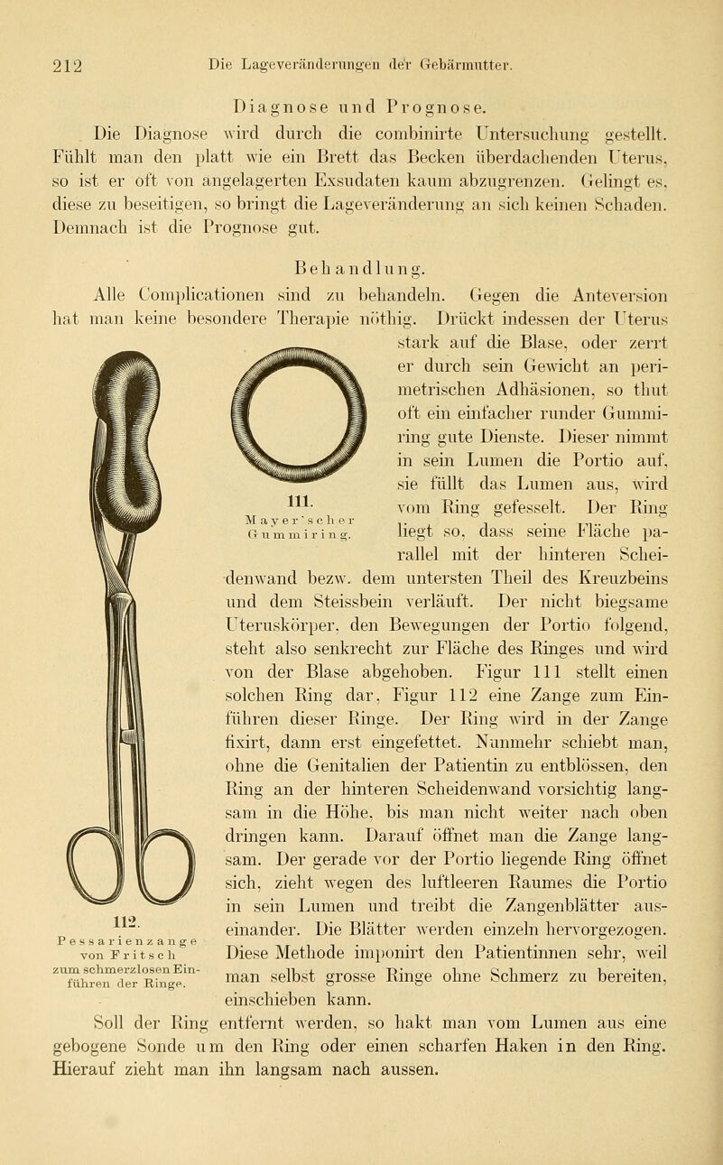 111. M a y e r ■ s c h e r G- u m m i r i n 0-. Diagnose und Prognose. Die Diagnose wird durch die combinirte Untersuchung gestellt. Fühlt man den platt wie ein Brett das Becken überdachenden Uterus, so ist er oft von angelagerten Exsudaten kaum abzugrenzen. Gelingt es, diese zu beseitigen, so bringt die Lageveränderung an sich keinen Schaden. Demnach ist die Prognose gut. Behandlung. Alle Complicationen sind zu behandeln. Gegen die Anteversion hat man keine besondere Therapie n()thig. Drückt indessen der Uterus stark auf die Blase, oder zerrt er durch sein Gewicht an peri- metrischen Adhäsionen, so thut oft ein einfacher runder Gummi- ring gute Dienste. Dieser nimmt in sein Lumen die Portio auf, sie füllt das Lumen aus, wird vom Ring gefesselt. Der Ring liegt so, dass seine Fläche pa- rallel mit der hinteren Schei- denwand bezw. dem untersten Theil des Kreuzbeins und dem Steissbein verläuft. Der nicht biegsame Uteruskörper, den Bewegungen der Portio folgend, steht also senkrecht zur Fläche des Ringes und wird von der Blase abgehoben. Figur 111 stellt einen solchen Ring dar, Figur 112 eine Zange zum Ein- führen dieser Ringe. Der Ring wird in der Zange fixirt, dann erst eingefettet. Nunmehr schiebt man, ohne die Genitalien der Patientin zu entblössen, den Ring an der hinteren Scheidenwand vorsichtig lang- sam in die Höhe, bis man nicht weiter nach oben dringen kann. Darauf öffnet man die Zange lang- sam. Der gerade vor der Portio liegende Ring öffnet sich, zieht wegen des luftleeren Raumes die Portio in sein Lumen und treibt die Zangenblätter aus- einander. Die Blätter werden einzeln hervorgezogen. Diese Methode imponirt den Patientinnen sehr, weil man selbst grosse Ringe ohne Schmerz zu bereiten, einschieben kann. Soll der Ring entfernt werden, so hakt man vom Lumen aus eine gebogene Sonde um den Ring oder einen scharfen Haken in den Ring. Hierauf zieht man ihn langsam nach aussen. Pessarienzange von F r i t s c h zum schmerzlosen Ein- führen der Ringe.