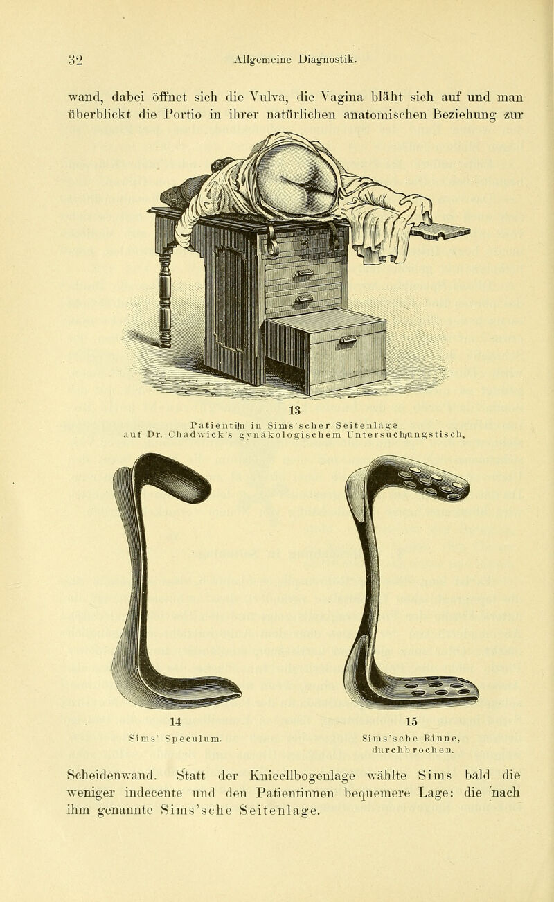 wand, dabei öffnet sich die Vulva, die Vagina bläht sich auf und man überblickt die Portio in ihrer natürlichen anatomischen Beziehung zur Patientiln in Siins'scher Seitenlage auf Dr. Chadwick'» gynäkologischem Untersnchjungstisch. 14 Sims' Speculum. 15 Sims'scbe Einne, (iurchb rochen. Scheiden wand. Statt der Knieellbogenlage wählte Sims bald die weniger indecente und den Patientinnen bequemere Lage: die rnach ihm genannte Sims'sche Seitenlas-e.