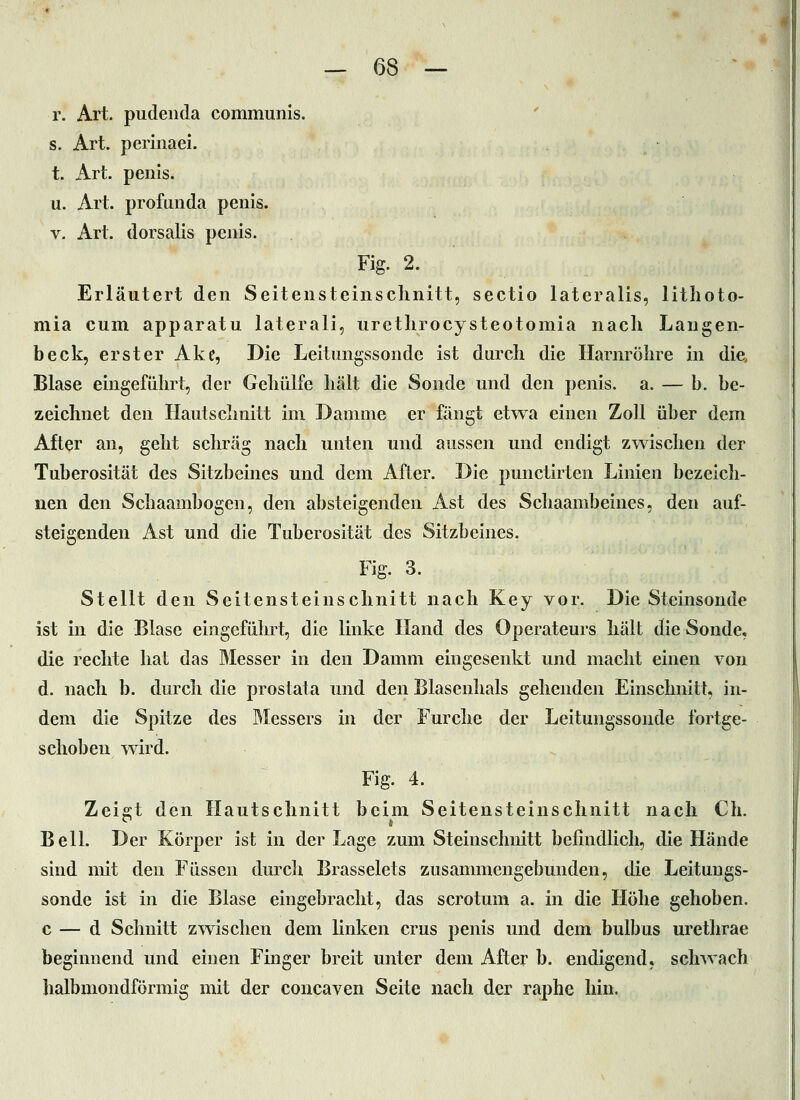 r. Art. pudenda communis. s. Art. perinaei. t. Art. penIs. u. Art. profunda penis. V. Art. dorsalis penis. Fig. 2. Erläutert den Seitensteinsclinitt, sectio lateralis, litlioto- mia cum apparatu laterali, uretlirocysteotomia nach Langen- beck, erster Ake, Die Leitungssonde ist durch die Harnröhre in die. Blase eingeführt, der Gehülfe hält die Sonde und den penis. a. — b. be- zeichnet den Hautschnitt im Damme er fängt etwa einen Zoll über dem After an, geht schräg nach unten und aussen und endigt zwischen der Tuberosität des Sitzbeines und dem After. Die punctirten Linien bezeich- nen den Schaambogen, den absteigenden Ast des Schaambeines, den auf- steigenden Ast und die Tuberosität des Sitzbeines. Fig. 3. Stellt den Seitensteinsclinitt nach Key vor. Die Steinsonde ist in die Blase eingeführt, die linke Hand des Operateurs hält die Sonde, die rechte hat das Messer in den Damm eingesenkt und macht einen von d. nach b. durch die prostata und den Blasenhals gehenden Einschnitt, in- dem die Spitze des Messers in der Furche der Leitungssonde fortge- schoben wird. Fig. 4. Zeigt den Hautschnitt beim Seitensteinsclinitt nach Ch. Bell. Der Körper ist in der Lage zum Steinschnitt befindlich, die Hände sind mit den Füssen durch Brasselets zusammengebunden, die Leitungs- sonde ist in die Blase eingebracht, das scrotum a. in die Höhe gehoben, c — d Schnitt zwischen dem linken crus penis und dem bulbus urethrae beginnend und einen Finger breit unter dem After b. endigend, schwach halbmondförmig mit der concaven Seite nach der raphe hin.