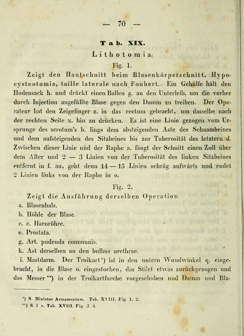 Tab. XIX. Lithotomla. Fig. 1. Zeigt den Hautschnitt beim Blasenkörperschnitt, Hypo- cysteotomia, taille laterale nach Foubert. Ein Gehülfe hält den Hodensack h. und drückt einen Ballen g. an den Unterleib, um die vorher durch Injection angefüllte Blase gegen den Damm zu treiben. Der Ope- rateur hat den Zeigefinger z. in das rectum gebracht, um dasselbe nach der rechten Seite x. hin zu drücken. Es ist eine Linie gezogen vom Ur- sprünge des scrotum's b. lings dem absteigenden Aste des Schaambeines und dem aufsteigenden des Sitzbeines bis zur Tuberosität des letztern d. Zwischen dieser Linie und der Raphe a. fängt der Schnitt einen Zoll über dem After und 2 — 3 Linien von der Tuberosität des linken Sitzbeines entfernt in f. an, geht denn 14 — 15 Linien schräg aufwärts und endet 2 Linien links von der Raphe in o. Fig. 2. Zeigt die Ausführung derselben Operation. a. Blasenhals. b. Höhle der Blase. c. c. Harnröhre, e. Prostata. g. Art. pudenda communis. k. Ast derselben an den bulbus urethrae. i. Mastdarm. Der Troikart*) ist in den untern Wundwinkel q. einge- bracht, in die Blase o. eingestochen, das Stilet etwas zurückgezogen und das Messer **) in der Troikartfurche vorgeschoben und Damm und Bla- •) S. Miniatur Armamentum. Tab. XVIlI. Fig 1. 2. ) S. 1 c. Tab. XVIII. Fi^-. 3. 4.