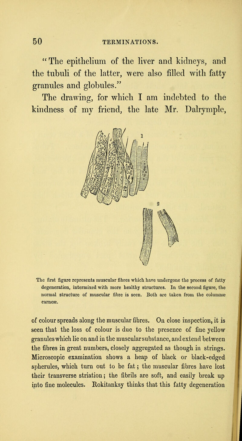 The epithelium of the liver and kidneys, and the tubuli of the latter, were also filled with fatty granules and globules. The drawing, for which I am indebted to the kindness of my friend, the late Mr. Dalrymple, The first figure represents muscular fibres which have undergone the process of fatty degeneration, intermixed with more healthy structures. In the second figure, the normal structure of muscular fibre is seen. Both are taken from the column* carnese. of colour spreads along the muscular fibres. On close inspection, it is seen that the loss of colour is due to the presence of fine yellow granules which lie on and in the muscular substance, and extend between the fibres in great numbers, closely aggregated as though in strings. Microscopic examination shows a heap of black or black-edged spherules, which turn out to be fat; the muscular fibres have lost their transverse striation; the fibrils are soft, and easily break up into fine molecules. Rokitanksy thinks that this fatty degeneration
