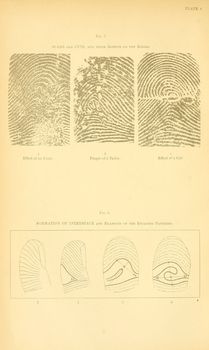 PLATE 4. Fig. SCARS AND CUTS, AND THRIR EFFECTS ON THE RiDOES. Effect of an Ulcer. Finjrer of a Tailor. Eflfect of a Gut. Fir.. S. FORMATION OP INTERSPACE and Examples of the Enclosed Patterns.