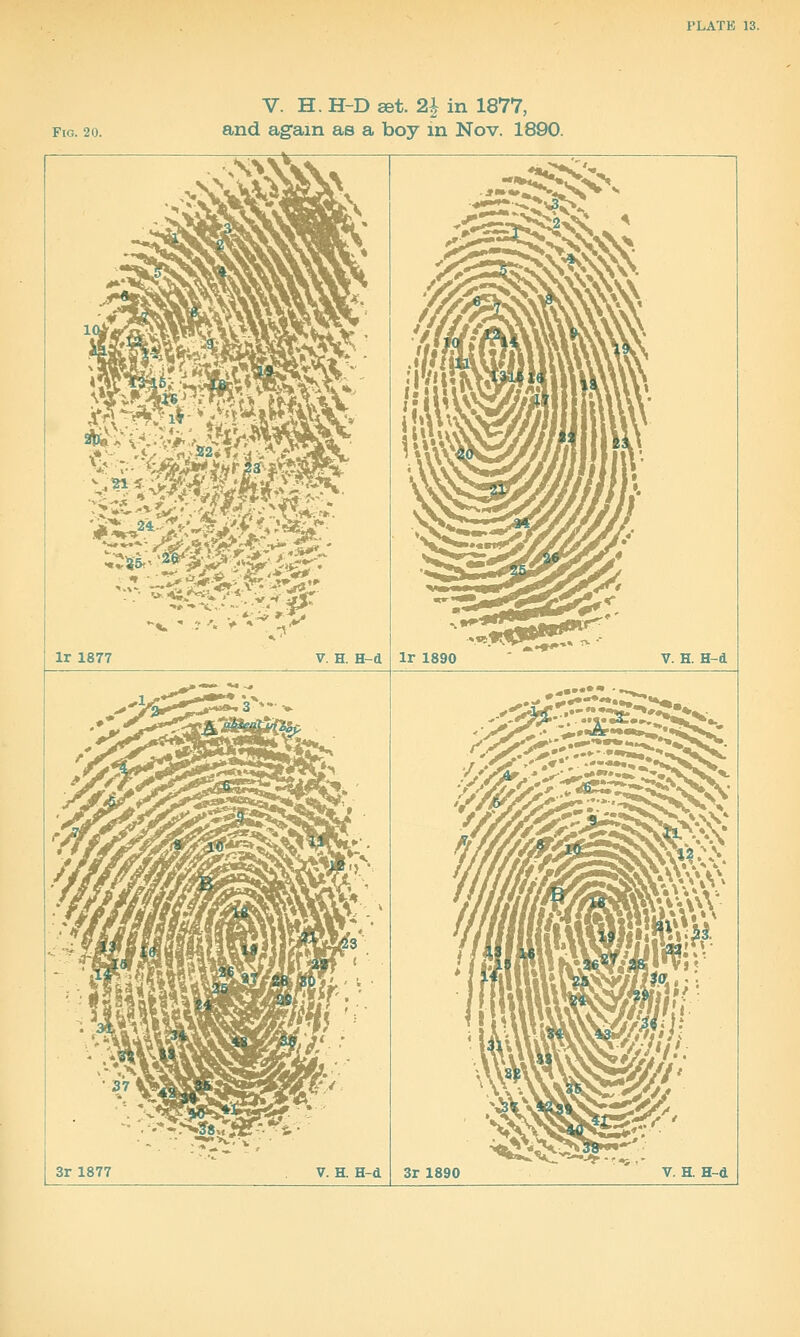 Fig. 20. V. H. H-D set. 2| in 1877, and again as a boy in Nov. 1890. ••*«^ —: -S^jf^r mf^ ji»t^ Ir 1877 V. H. H-d =^^^^ '$^^ * Ir 1890 V. H. H-d 3r 1877 V. H. H-d 3r 1890 —-*--*,- V. H. H-d