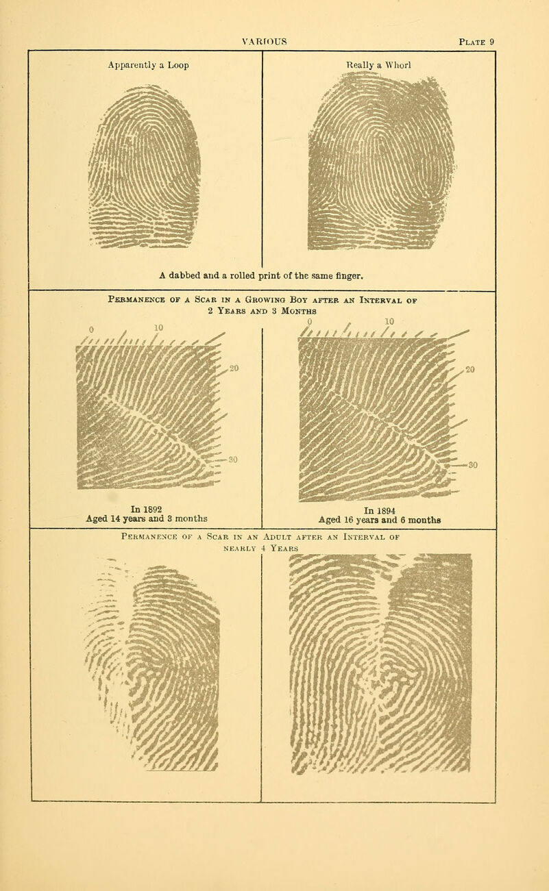 Apparently a Loop Really a Whorl A dabbed and a rolled print of the same finger. pfibmanence of a scar in a gbowina boy after an interval of 2 Years aud 3 Months /////////i In 1892 14 years and 3 months In 1894 Aged 16 years and 6 months Permanence of a Scar in an Adult after an Interval of