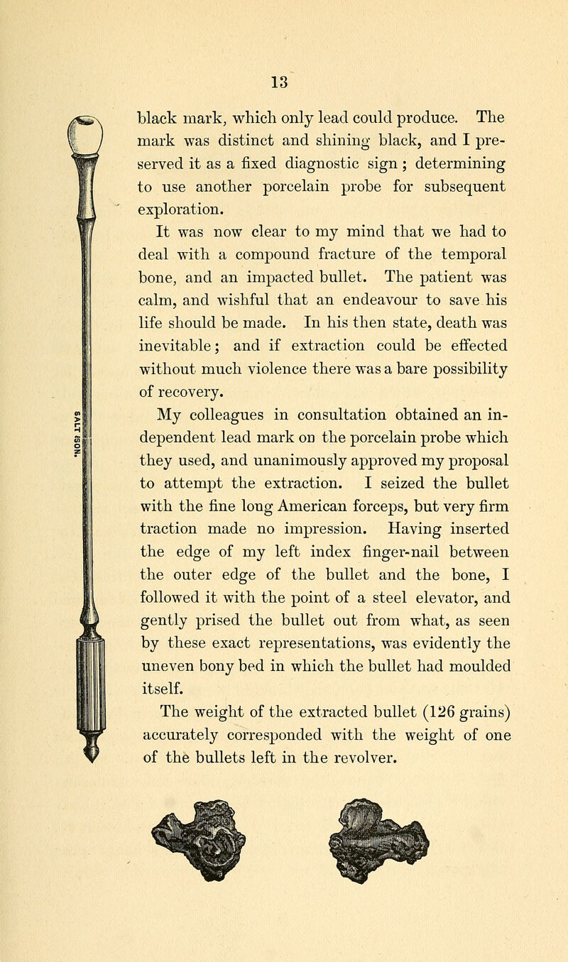 black mark, which only lead could produce. The mark was distinct and shining black, and I pre- served it as a fixed diagnostic sign ; determining to use another porcelain probe for subsequent exploration. It was now clear to my mind that we had to deal with a compound fracture of the temporal bone, and an impacted bullet. The patient was calm, and wishful that an endeavour to save his life should be made. In his then state, death was inevitable; and if extraction could be effected without much violence there was a bare possibility of recovery. My colleagues in consultation obtained an in- dependent lead mark on the porcelain probe which they used, and unanimously approved my proposal to attempt the extraction. I seized the bullet with the fine long American forceps, but very firm traction made no impression. Having inserted the edge of my left index finger-nail between the outer edge of the bullet and the bone, I followed it with the point of a steel elevator, and gently prised the bullet out from what, as seen by these exact representations, was evidently the uneven bony bed in which the bullet had moulded itself. The weight of the extracted bullet (126 grains) accurately corresponded with the weight of one of the bullets left in the revolver. !#8iisiii