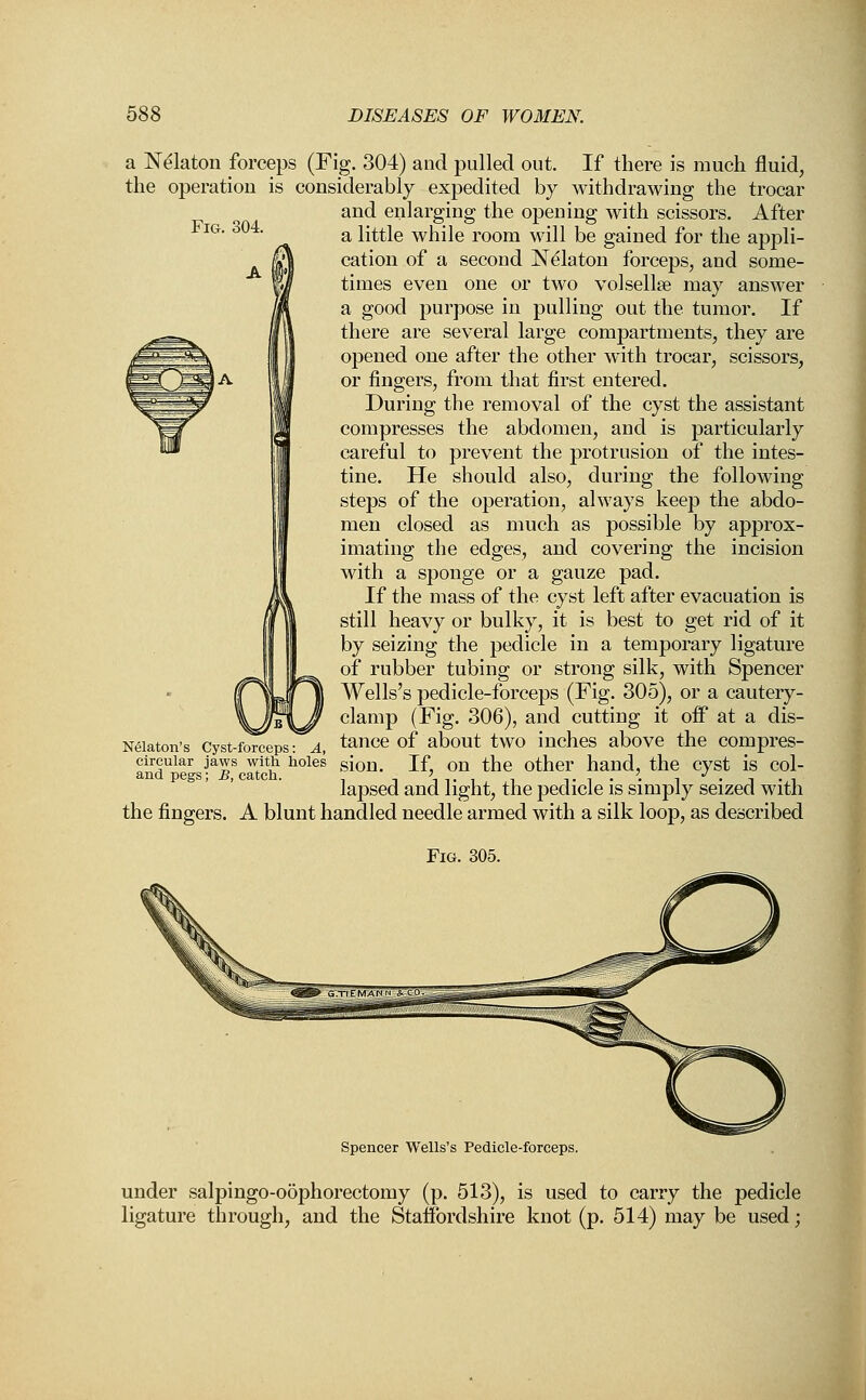 Fig. 304. a Nekton forceps (Fig. 304) and pulled out. If there is much fluid, the operation is considerably expedited by withdrawing the trocar and enlarging the opening with scissors. After a little while room will be gained for the appli- cation of a second Nekton forceps, and some- times even one or two vol sella? may answer a good purpose in pulling out the tumor. If there are several large compartments, they are opened one after the other with trocar, scissors, or fingers, from that first entered. During the removal of the cyst the assistant compresses the abdomen, and is particularly careful to prevent the protrusion of the intes- tine. He should also, during the following steps of the operation, always keep the abdo- men closed as much as possible by approx- imating the edges, and covering the incision with a sponge or a gauze pad. If the mass of the cyst left after evacuation is still heavy or bulky, it is best to get rid of it by seizing the pedicle in a temporary ligature of rubber tubing or strong silk, with Spencer Wells's pedicle-forceps (Fig. 305), or a cautery- clamp (Fig. 306), and cutting it off at a dis- tance of about two inches above the compres- sion. If, on the other hand, the cyst is col- lapsed and light, the pedicle is simply seized with the fingers. A blunt handled needle armed with a silk loop, as described Nelaton's Cyst-forceps: A, circular jaws with holes and pegs; B, catch. Fig. 305. Spencer Wells's Pedicle-forceps. under salpingo-oophorectomy (p. 513), is used to carry the pedicle ligature through, and the Staffordshire knot (p. 514) may be used;