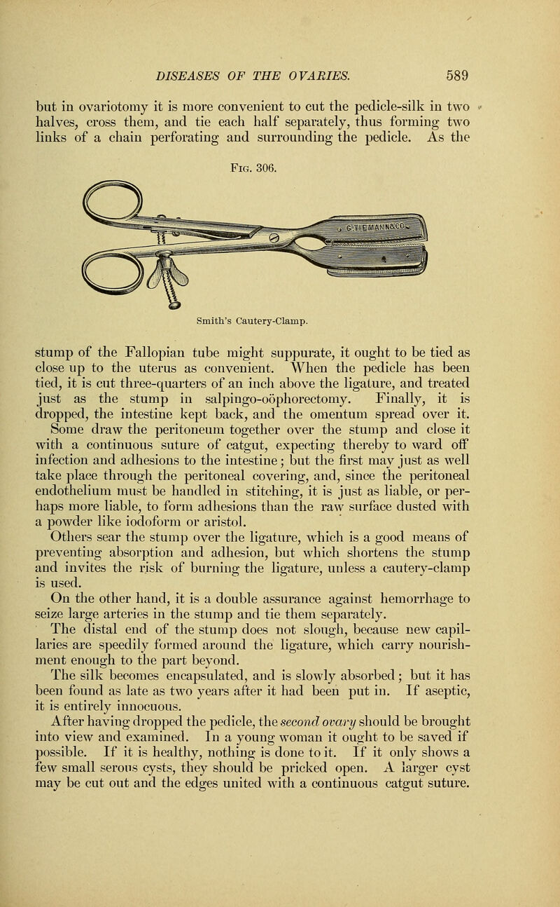 but in ovariotomy it is more convenient to cut the pedicle-silk in two halves, cross them, and tie each half separately, thus forming two links of a chain perforating and surrounding the pedicle. As the Fig. 306. '^^q^rm^<M§^i Smith's Cautery-Clamp. stump of the Fallopian tube might suppurate, it ought to be tied as close up to the uterus as convenient. When the pedicle has been tied, it is cut three-quarters of an inch above the ligature, and treated just as the stump in salpingo-oophorectomy. Finally, it is dropped, the intestine kept back, and the omentum spread over it. Some draw the peritoneum together over the stump and close it with a continuous suture of catgut, expecting thereby to ward off infection and adhesions to the intestine; but the first may just as well take place through the peritoneal covering, and, since the peritoneal endothelium must be handled in stitching, it is just as liable, or per- haps more liable, to form adhesions than the raw surface dusted with a powder like iodoform or aristol. Others sear the stump over the ligature, which is a good means of preventing absorption and adhesion, but which shortens the stump and invites the risk of burning the ligature, unless a cautery-clamp is used. On the other hand, it is a double assurance against hemorrhage to seize large arteries in the stump and tie them separately. The distal end of the stump does not slough, because new capil- laries are speedily formed around the ligature, which carry nourish- ment enough to the part beyond. The silk becomes encapsulated, and is slowly absorbed; but it has been found as late as two years after it had been put in. If aseptic, it is entirely innocuous. After having dropped the pedicle, the second ovary should be brought into view and examined. In a young woman it ought to be saved if possible. If it is healthy, nothing is done to it. If it only shows a few small serous cysts, they should be pricked open. A larger cyst may be cut out and the edges united with a continuous catgut suture.