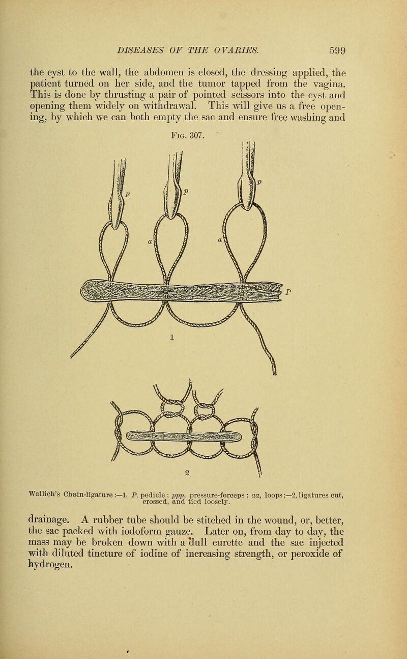 the cyst to the wall, the abdomen is closed, the dressing applied, the patient turned on her side, and the tumor tapped from the vagina. This is done by thrusting a pair of pointed scissors into the cyst and opening them widely on withdrawal. This will give us a free open- ing, by which we can both empty the sac and ensure free washing and Fig. 307. Wallich's Chain-ligature: -1. P, pedicle ; ppp, pressure-forceps ; aa, loops;—2, ligatures cut, crossed, and tied loosely. drainage. A rubber tube should be stitched in the wound, or, better, the sac packed with iodoform gauze. Later on, from day to day, the mass may be broken down with a Hull curette and the sac injected with diluted tincture of iodine of increasing strength, or peroxide of hydrogen.