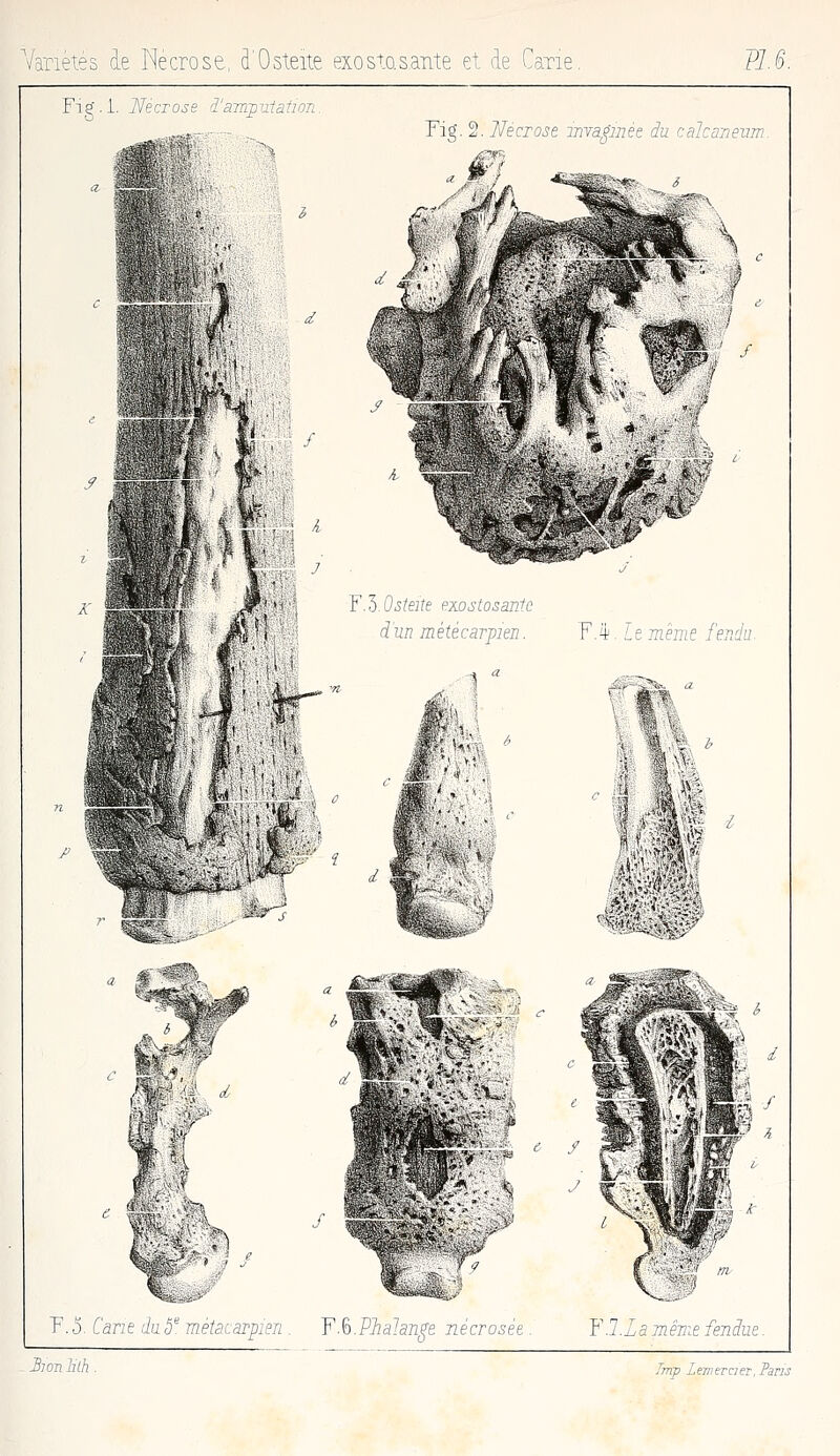 Variétés de Nécrose, d'Ostéite exos+o.sante et, de C aTie VJ.S. Fig . i. UecToss î'aTTrpuiation^ Fig. 2. Nécrose wra^mee du calca'n fi ^iS dm métécarpien. Y.ii. le même fendu Y.1). Ostéite exostosantc y 4 ^ /il # ?' ^?3ï<^j| F.5. Cane du 5' métacarpien . Y.%.Pdialan^e nécrosée F.7. La même fendue. B:on lilh .