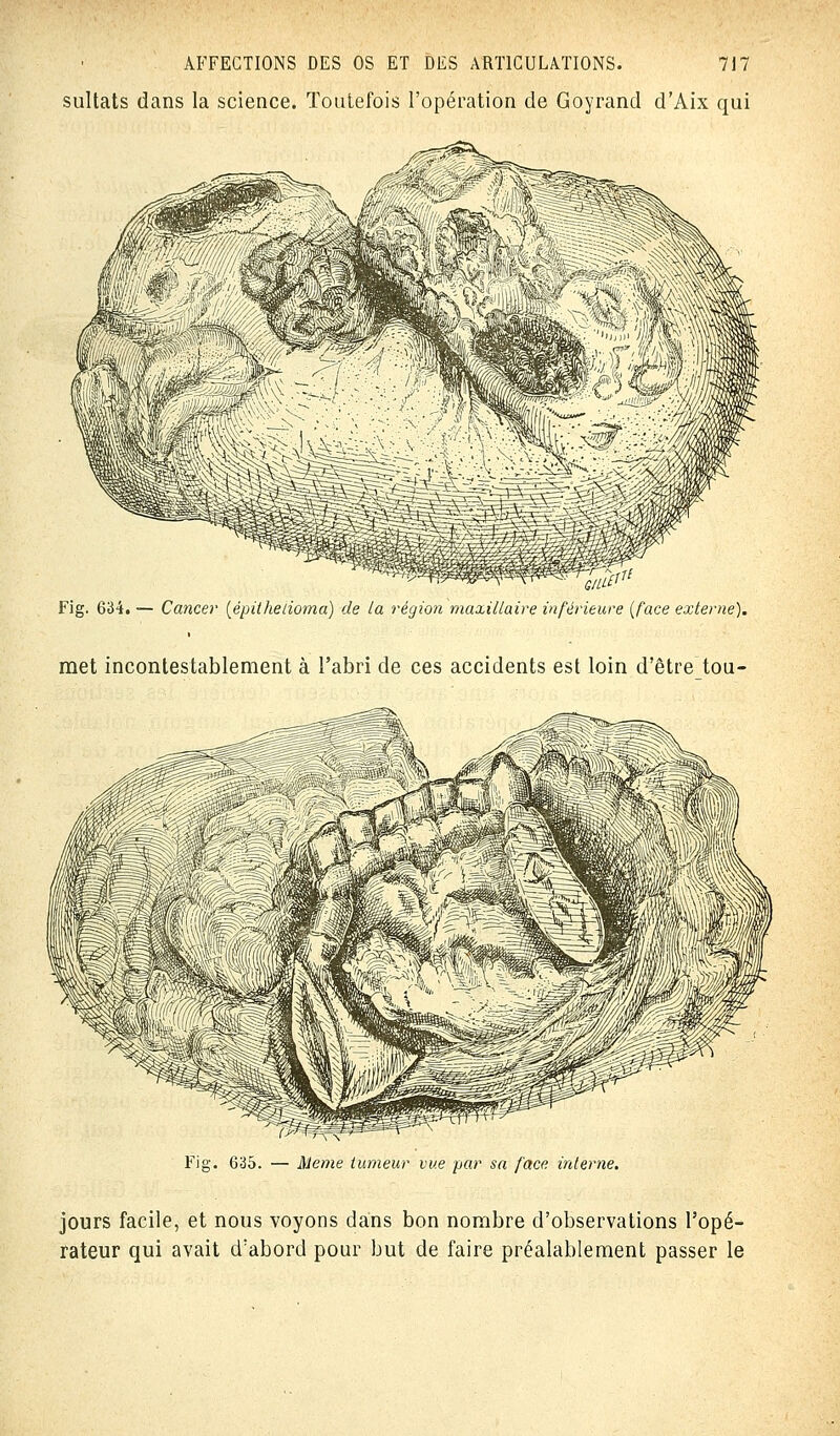 sultats dans la science. Toutefois l'opération de Goyrand d'Aix qui uifcu Fig. 634. — Cancer (épithetioma) de la région maxillaire inférieure {face externe). met incontestablement à l'abri de ces accidents est loin d'être tou- Fig. 635. — Même tumeur vue par sa face interne. jours facile, et nous voyons dans bon nombre d'observations l'opé- rateur qui avait d'abord pour but de faire préalablement passer le