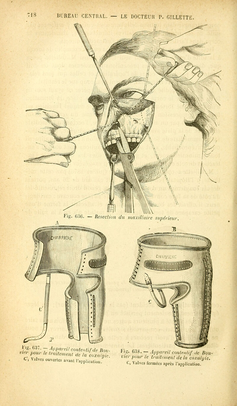 Fig. 636. — Resection du maxillaire supérieur. l'ig. 637. — Appareil contentif de Bon nev pour le traitement de la coLlS C , Vulves ouvertes ayant l'application. Fis. 638. — Appareil contentéf de Bou- vier pour le traitement de la coxalgie. C, Valves fermées après l'application.