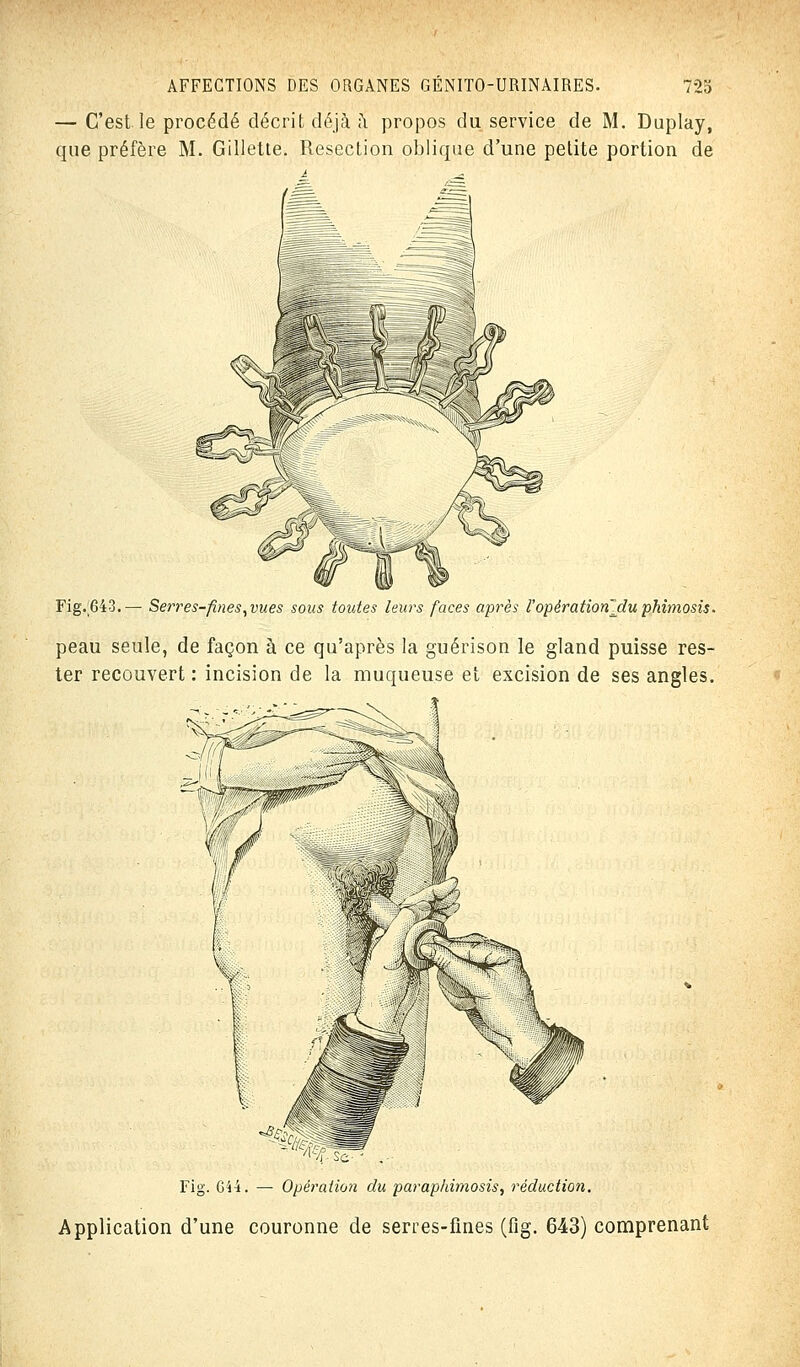 — C'est le procédé décrit déjà a propos du service de M. Duplay, que préfère M. Gillette. Resection oblique d'une petite portion de Fig/643.— Serres-fines,vues sous toutes leurs faces après VopératiorCdu phimosis. peau seule, de façon à ce qu'après la guérison le gland puisse res- ter recouvert : incision de la muqueuse et excision de ses angles. Fig. G44. — Opération du paraphimosis, réduction. Application d'une couronne de serres-fines (fig. 643) comprenant