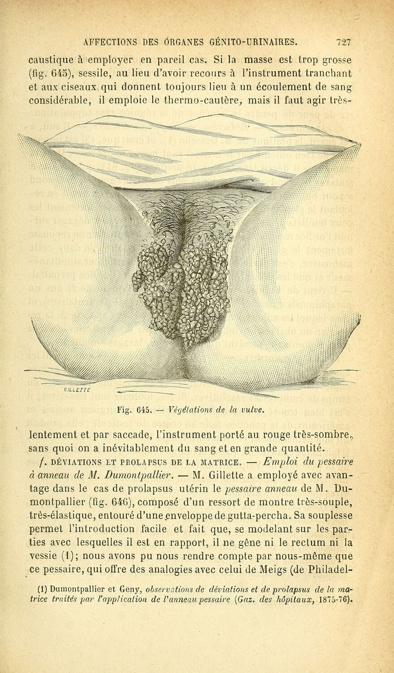caustique à employer en pareil cas. Si la masse est trop grosse (fig. 645), sessile, au lieu d'avoir recours à l'instrument tranchant et aux ciseauXxqui donnent toujours lieu à un écoulement de sang considérable, il emploie le thermo-cautère, mais il faut agir très- Fig. 645. — Végétations de la vulve. lentement et par saccade, l'instrument porté au rouge très-sombre? sans quoi on a inévitablement du sang et en grande quantité. /. déviations et prolapsus de la matrice. — Emploi du pessaire à anneau de M. Dumontpallier. — M. Gillette a employé avec avan- tage dans le cas de prolapsus utérin le pessaire anneau de M. Du- montpallier (fig. 646), composé d'un ressort de montre très-souple, très-élastique, entouré d'une enveloppe de gutta-percha. Sa souplesse permet l'introduction facile et fait que, se modelant sur les par- ties avec lesquelles il est en rapport, il ne gêne ni le rectum ni la vessie (1); nous avons pu nous rendre compte par nous-même que ce pessaire, qui offre des analogies avec celui de Meigs (de Philadel- (1) Dumontpallier et Geny, observations de déviations et de prolapsus de la ma- trice traités par l'application de Vanneau pessaire {Gaz. des hôpitaux, 1875-76).
