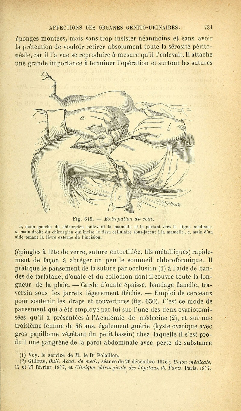 éponges montées, mais sans trop insister néanmoins et sans avoir la prétention de vouloir retirer absolument toute la sérosité périto- néale,car il l'a vue se reproduire à mesure qu'il l'enlevait. Il attache une grande importance à terminer l'opération et surtout les sutures Extirpation du sein. a, main gauche du chirurgien soulevant la mamelle et la portant vers la ligne médiane; b, main droite du chirurgien qui incise le tissu cellulaire sous-jacent à la mamelle; c, main d'un aide tenant la lèvre externe de l'incision. (épingles à tête de verre, suture entortillée, fils métalliques) rapide- ment de façon à abréger un peu le sommeil chloroformique. Il pratique le pansement de la suture par occlusion (1) à l'aide de ban- des de tarlatane, d'ouate et du collodion dont il couvre toute la lon- gueur de la plaie. —Garde dJouate épaisse, bandage flanelle, tra- versin sous les jarrets légèrement fléchis. — Emploi de cerceaux pour soutenir les draps et couvertures (6g. 650). C'est ce mode de pansement qui a été employé par lui sur l'une des deux ovariotomi- sées qu'il a présentées à l'Académie de médecine (2), et sur une troisième femme de 46 ans, également guérie (kyste ovarique avec gros papillome végétant du petit bassin) chez laquelle il s'est pro- duit une gangrène de la paroi abdominale avec perte de substance (1) Voy. le service de M. le Dr Polaillon. (2) Gillette, Bull. Acad. de méd., séance du 26 décembre 1876 ; Union médicale, 12 et 27 février 1877., et Clinique chirurgicale des hôpitaux de Paris. Paris, 1877.