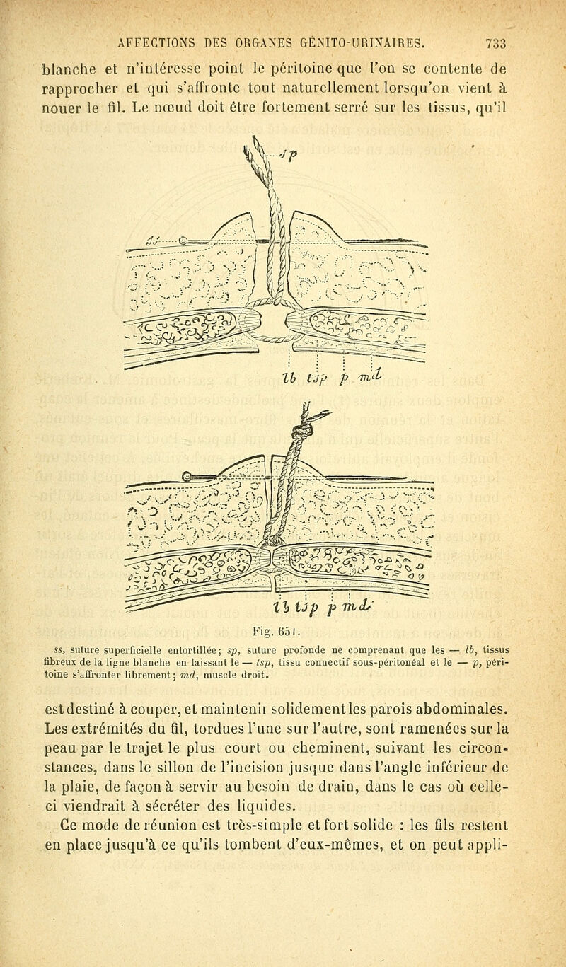 blanche et n'intéresse point le périloine que l'on se contente de rapprocher et qui s'affronte tout naturellement lorsqu'on vient à nouer le fil. Le nœud doit être fortement serré sur les tissus, qu'il Fig. 651. ss, suture superficielle entortillée; sp, suture profonde ne comprenant que les — Ib, tissus fibreux de la ligne blanche en laissant le — tsp, tissu conuectif sous-péritonéal et le — p, péri- toine s'affronter librement; md, muscle droit. est destiné à couper, et maintenir solidement les parois abdominales. Les extrémités du fil, tordues l'une sur l'autre, sont ramenées sur la peau par le trajet le plus court ou cheminent, suivant les circon- stances, dans le sillon de l'incision jusque dans l'angle inférieur de la plaie, de façon à servir au besoin de drain, dans le cas où celle- ci viendrait à sécréter des liquides. Ce mode de réunion est très-simple et fort solide : les fils restent en place jusqu'à ce qu'ils tombent d'eux-mêmes, et on peut appli-