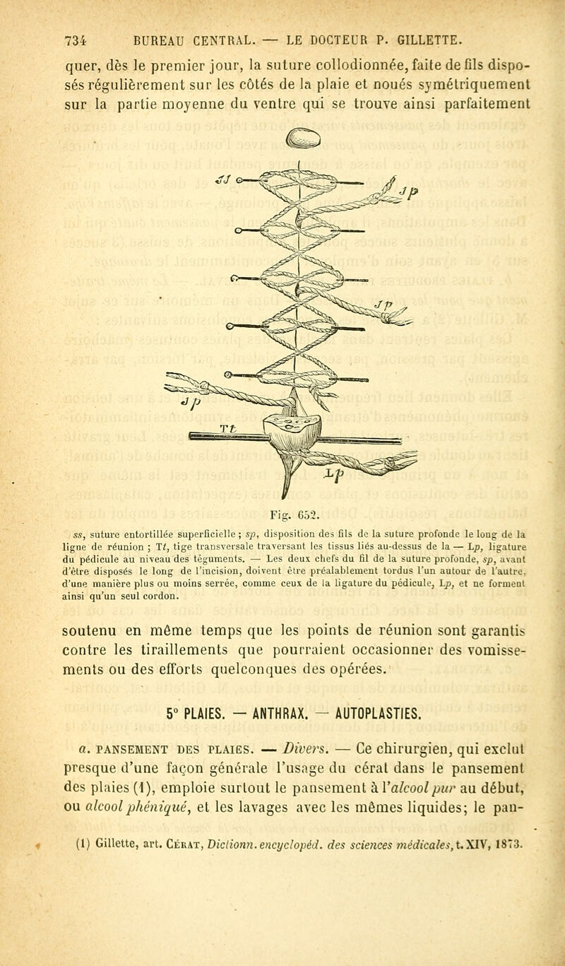 quer, dès le premier jour, la suture collodionnée, faite de fils dispo- sés régulièrement sur les côtés de la plaie et noués symétriquement sur la partie moyenne du ventre qui se trouve ainsi parfaitement Fi g. 652. ss, suture entortillée superficielle ; sp, disposition des fils de la suture profonde le long de la ligne de réunion ; 17, tige transversale traversant les tissus liés au-dessus de la — Lp, ligature du pédicule au niveau des téguments. — Les deux chefs du fil de la suture profonde, sp, avant d'être disposés le long de l'incision, doivent être préalablement tordus l'un autour de l'autre, d'une manière plus ou moins serrée, comme ceux de la ligature du pédicule, Lp, et ne formenl ainsi qu'un seul cordon. soutenu en môme temps que les points de réunion sont garantis contre les tiraillements que pourraient occasionner des vomisse- ments ou des efforts quelconques des opérées. 5° PLAIES. - ANTHRAX. - AUTOPLASTIES. a. pansement des plaies. — Divers. — Ce chirurgien, qui exclut presque d'une façon générale l'usage du cérat dans le pansement des plaies (\), emploie surtout le pansement kl'alcool pur au début, ou alcoolphéniqué, et les lavages avec les mêmes liquides; le pan- (1) Gillette, art. Cérat, Diclionn.encyclopéd. des sciences médicales, t. XIV, 1873.