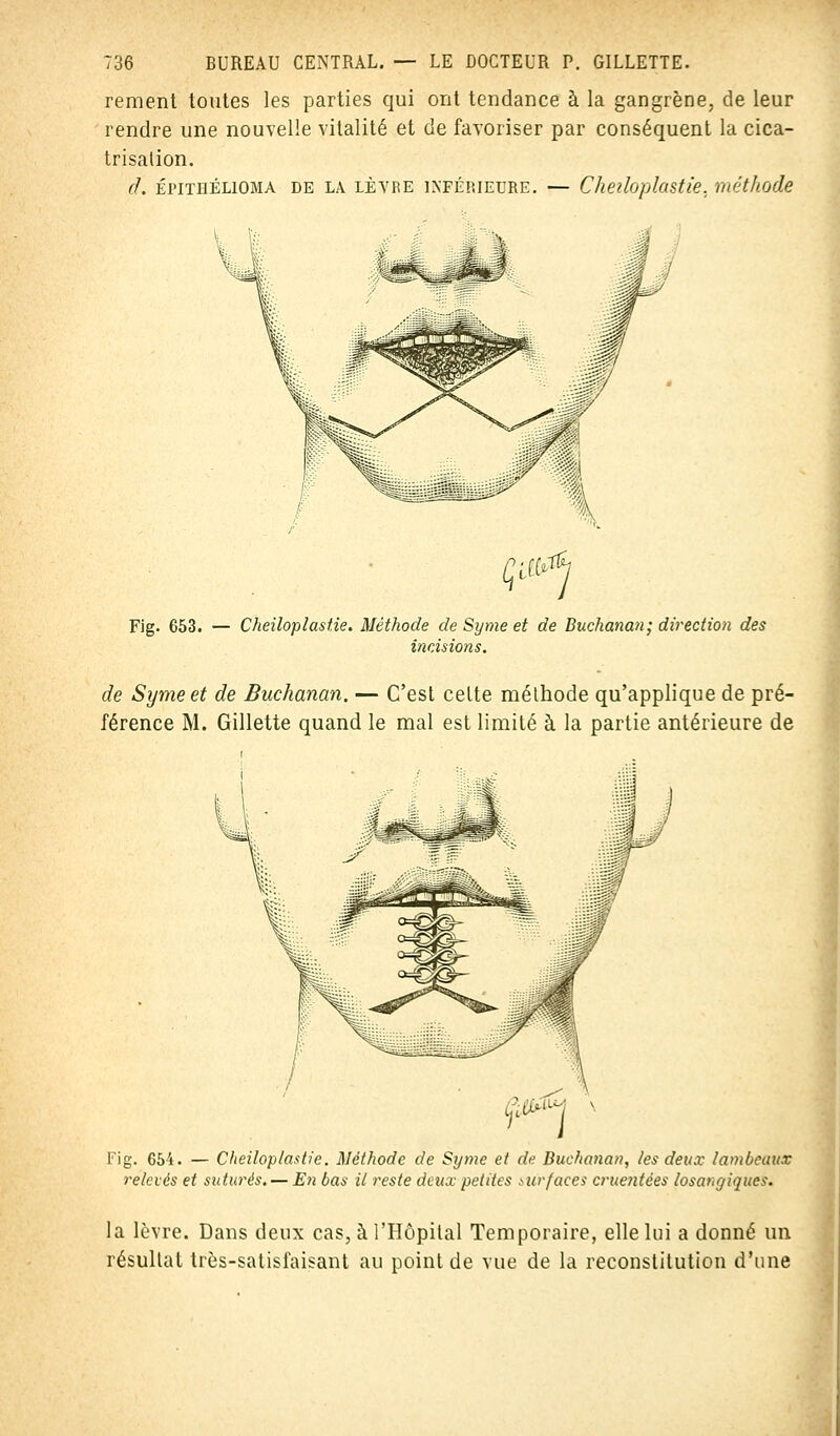 rement toutes les parties qui ont tendance à la gangrène, de leur rendre une nouvelle vitalité et de favoriser par conséquent la cica- trisation. (L ÉPITHÉL10MA DE LA LÈVRE INFÉRIEURE. — CheiloplùStie. méthode Çiurf Fig. 653. Cheiloplastie. Méthode de Syme et de Buchanan; direction des incisions. de Syrneet de Buchanan. — C'est cette méthode qu'applique de pré- férence M. Gillette quand le mal est limité à la partie antérieure de Fig. 654. — Cheilop/a.itie. Méthode de Syme et de Buchanan, tes deux lambeaux relevés et suturés. — En bas il reste deux petites surfaces cruentées losar,giques. la lèvre. Dans deux cas, à l'Hôpital Temporaire, elle lui a donné un résultat très-satisfaisant au point de vue de la reconstitution d'une