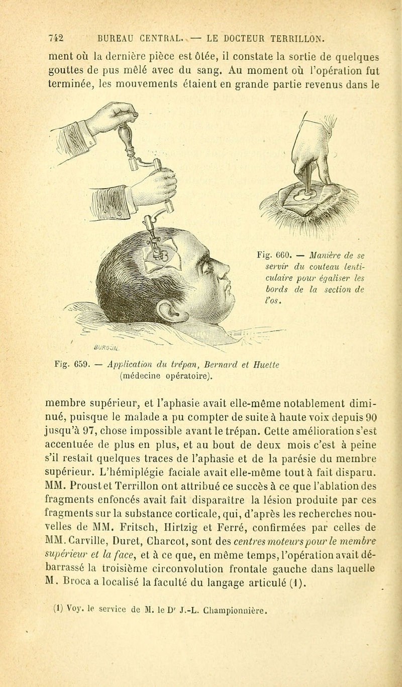 ment où la dernière pièce est ôlée, il constate la sortie de quelques gouttes de pus mêlé avec du sang. Au moment où l'opération fut terminée, les mouvements étaient en grande partie revenus dans le Fig. 660. — Manière de se servir du couteau lenti- culaire pour égaliser les bords de la section de l'os. BURS-UN, Fig. 659. — Application du trépan, Bernard et Huette (médecine opératoire). membre supérieur, et l'aphasie avait elle-même notablement dimi- nué, puisque le malade a pu compter de suite à haute voix depuis 90 jusqu'à 97, chose impossible avant le trépan. Cette amélioration s'est accentuée de plus en plus, et au bout de deux mois c'est à peine s'il restait quelques traces de l'aphasie et de la parésie du membre supérieur. L'hémiplégie faciale avait elle-même tout à fait disparu. MM. Proust et Terrillon ont attribué ce succès à ce que l'ablation des fragments enfoncés avait fait disparaître la lésion produite par ces fragments sur la substance corticale, qui, d'après les recherches nou- velles de MM. Fritsch, Hirtzig et Ferré, confirmées par celles de MM. Carville, Duret, Charcot, sont des centres moteurs pour le membre supérieur et la face, et à ce que, en même temps, l'opération avait dé- barrassé la troisième circonvolution frontale gauche dans laquelle M. Broca a localisé la faculté du langage articulé (I). (1) Voy. le service de M. le D1 J.-L. Championnière.