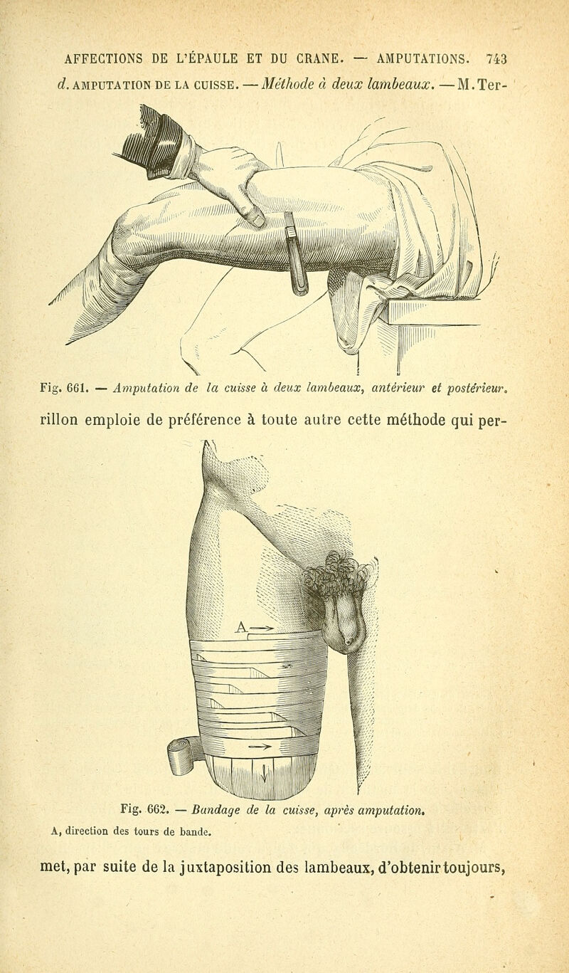 d. amputation de la cuisse. —Méthode à deux lambeaux. —M.Ter- Fig. 661. — Amputation de la cuisse à deux lambeaux, antérieur et postérieur. rillon emploie de préférence à toute autre cette méthode qui per- Fig. 662. — Bandage de la cuisse, après amputation. À, direction des tours de bande. met, par suite de la juxtaposition des lambeaux, d'obtenir toujours,