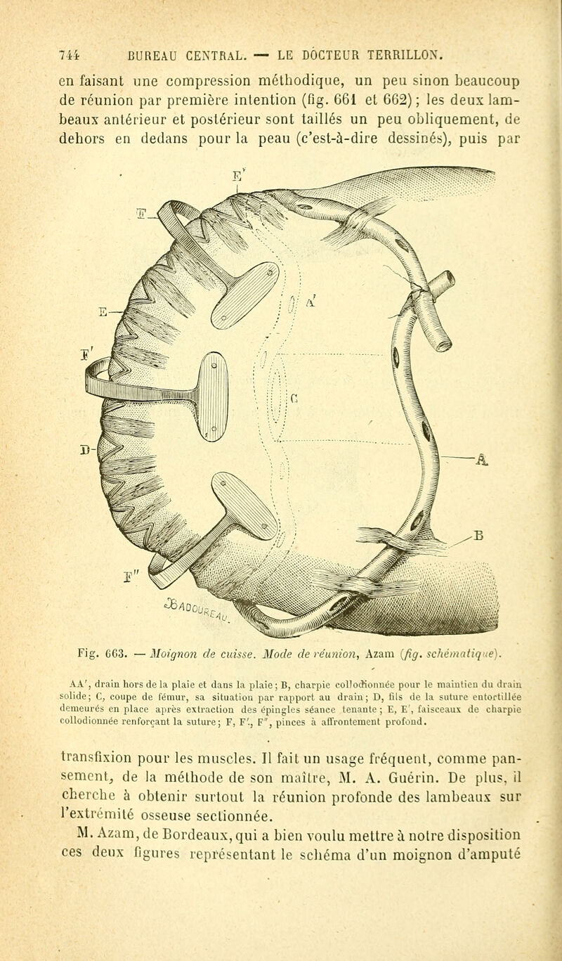 en faisant une compression méthodique, un peu sinon beaucoup de réunion par première intention (fig. 661 et 662); les deux lam- beaux antérieur et postérieur sont taillés un peu obliquement, de dehors en dedans pour la peau (c'est-à-dire dessinés), puis par Fig. 663. — Moignon de caisse. Mode de réunion, Azam (fig. I AA', drain hors de la plaie et dans la plaie ; B, charpie eollocrionnée pour le maintien du drain solide; C, coupe de fémur, sa situation par rapport au drain; D, fils de la suture entortillée demeurés en place après extraction des épingles séance tenante; E, E', faisceaux de charpie collodionnée renforçant la suture; F, F'., F, pinces à affrontement profond. transfixion pour les muscles. Il fait un usage fréquent, comme pan- sement, de la méthode de son maître, M. A. Guérin. De plus, il cherche à obtenir surtout la réunion profonde des lambeaux sur l'extrémité osseuse sectionnée. M. Azam, de Bordeaux, qui a bien voulu mettre à notre disposition ces deux figures représentant le schéma d'un moignon d'amputé