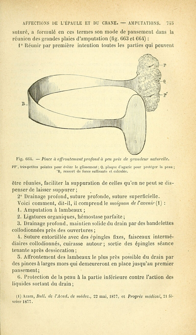 suturé, a formulé en ces termes son mode de pansement dans la réunion des grandes plaies d'amputation (fig. 663 et 664) : 1° Réunir par première intention toutes les parties qui peuvent Fig. 664. — Pince à affrontement profond à peu près de grandeur naturelle. PP', très-petites pointes pour éviter le glissement; Q, plaque d'agaric pour protéger la peau; 'R, ressort de force suffisante et calculée. être réunies, faciliter la suppuration de celles qu'on ne peut se dis- penser de laisser suppurer ; 2° Drainage profond, suture profonde, suture superficielle. Voici comment, dit-il, il comprend le moignon de l'avenir (1) : 1. Amputation à lambeaux ; 2. Ligatures organiques, hémostase parfaite ; 3. Drainage profond, maintien solide du drain par des bandelettes collodionnées près des ouvertures; 4. Suture entortillée avec des épingles fixes, faisceaux intermé- diaires collodionnés, cuirasse autour ; sortie des épingles séance tenante après dessiccation; 5. Affrontement des lambeaux le plus près possible du drain par des pinces à larges mors qui demeureront en place jusqu'au premier pansement; ' 6. Protection de la peau à la partie inférieure contre l'action des liquides sortant du drain ; (1) Azam, Bull, de l'Acad. de médec, 22 mai, 1877, et Progrès médical, 21 fé- vrier 1877.