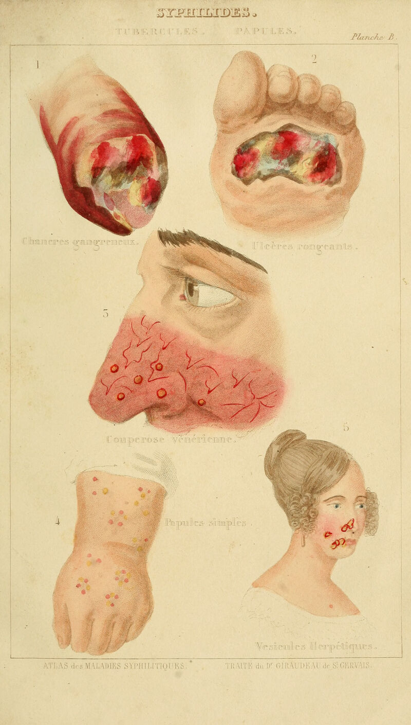 SRnwsaäwx&- i i'> !■, w 2>la*u ov so Q ... <t£'9 'vi ()! . e= ^ • LADIES SYPHI1 . TR UTl'i du Dr Gl'PJU DKM