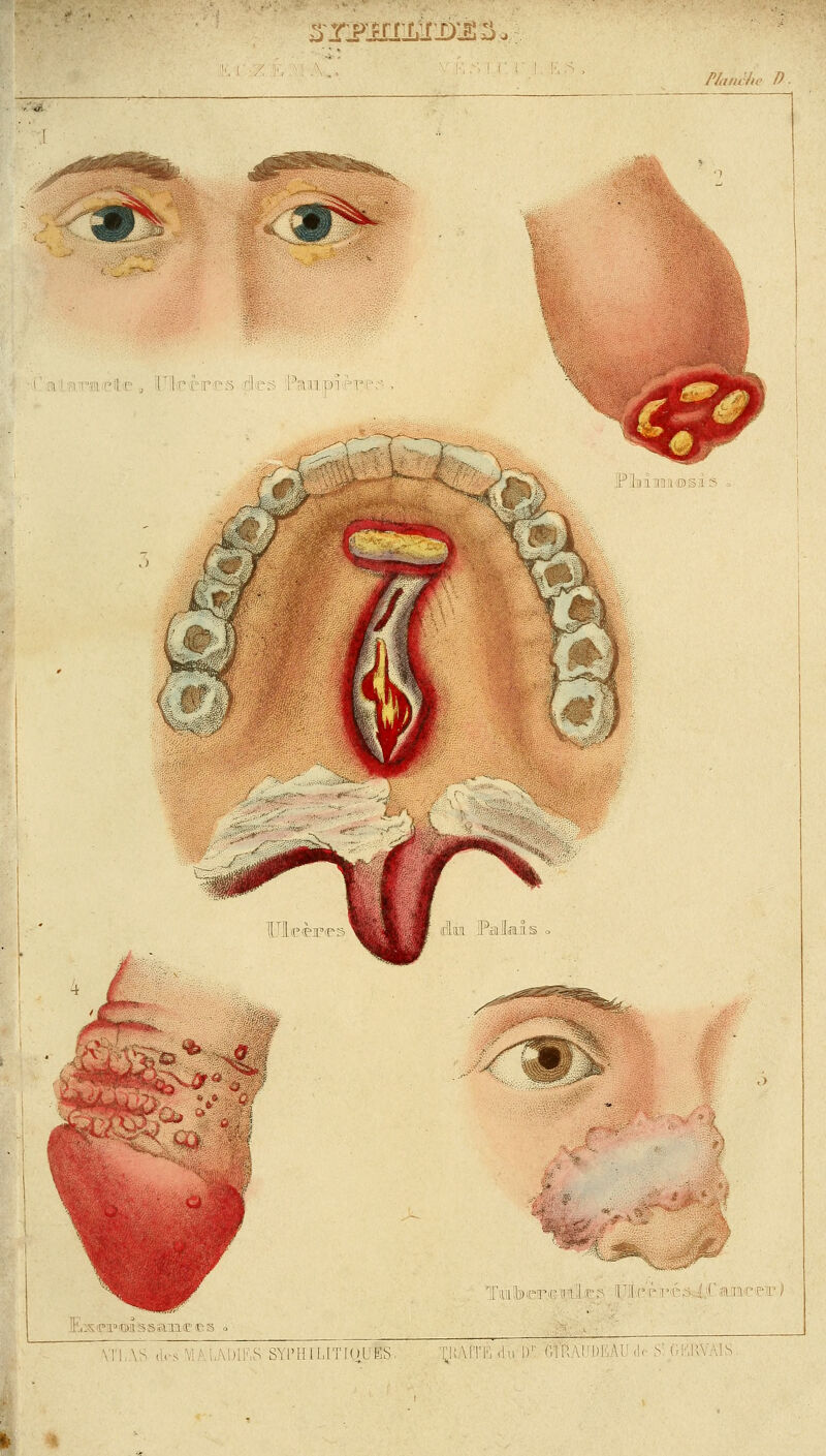 srswnk&xs*, Planche D. ■ ■■:' .. !' l.c i i 'um . i i i i©§i 2 ■ [»HJUSg .i 1 I i i s :'iil;).;-i^i' n I es i i'.C'P ' ' ■' VTL.VS des ' S SYl'HILITCCiUÄS-. '^liAfTE du l)r-Cr! RÄUDEA1 d< S'.GKRVÄIS