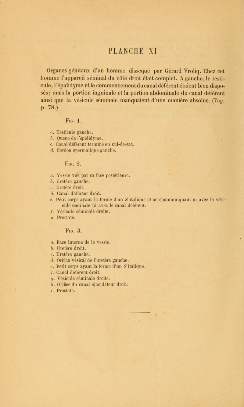 Organes génitaux d'un homme disséqué par Gérard Vroliq. Chez cet homme l'appareil séminal du côté droit était complet. A gauche, le testi- cule, l'épididyme et le commencement du canal déférent étaient bien dispo- sés; mais la portion inguinale et la portion abdominale du canal déférent ainsi que la vésicule séminale manquaient d'une manière absolue. (Voy. p. 78.) FiG. 1. a. Testicule gauche. h. Queue de l'épididyme. c. Canal déférent terminé en cul-de-sac. d. Cordon spermatique gauche. FiG. 2. a. Vessie vue par sa face postérieure. h. Uretère gauche. c. Uretère droit. d. Canal déférent droit. e. Petit corps ayant la forme d'un S italique et ne communiquant ni avec la vési- cule séminale ni avec le canal déférent. /'. Vésicule séminale droite. g. Prostate. FiG. 3. a. Face interne de la vessie. b. Uretère droit. c. Uretère gauche. d. Orifice vésical de l'uretère gauche. <?. Petit corps ayant la forme d'un S italique. /'. Canal déférent droit. g. Vésicule séminale droite. h. Orifice du canal éjaculateur droit. i. Prostate.