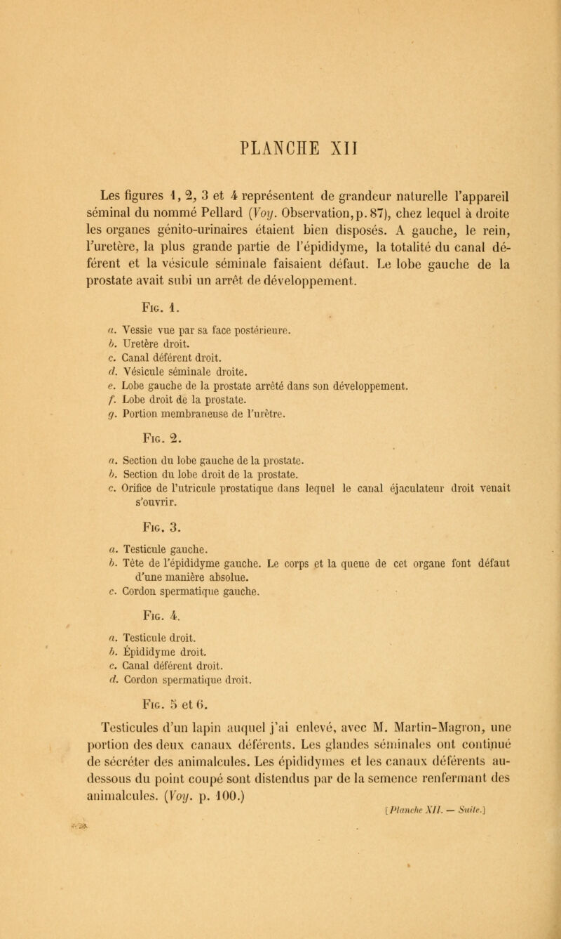 Les figures 1, 2^ 3 et 4 représentent de grandeur naturelle l'appareil séminal du nommé Pellard {Voy. Observation,p. 87), chez lequel à droite les organes génito-urinaires étaient bien disposés. A gauche, le rein, Turetère, la plus grande partie de l'épididyme, la totalité du canal dé- férent et la vésicule séminale faisaient défaut. Le lobe gauche de la prostate avait subi un arrêt de développement. FiG. i. a. Vessie vue par sa face postérieure. b. Uretère droit. c. Canal déférent droit. d. Vésicule séminale droite. e. Lobe gauche de la prostate arrêté dans son développement. f. Lobe droit de la prostate. g. Portion membraneuse de Turètre. FiG. 2. a. Section du lobe gauche de la prostate. h. Section du lobe droit de la prostate. c. Orifice de Tutricule prostatique dans lequel le canal éjaculateur droit venait s'ouvrir. FiG. 3. a. Testicule gauche. h. Tète de l'épididyme gauche. Le corps et la queue de cet organe font défaut d'une manière absolue. c. Gordon spermatique gauche. FiG. 4. a. Testicule droit. h. Épididyme droit, c. Canal déférent droit. d. Cordon spermatique droit. FiG. 5 et 6. Testicules d'un lapin auquel j'ai enlevé, avec M. Martin-Magron, une portion des deux canaux déférents. Les glandes séminales ont continué de sécréter des animalcules. Les épididymes et les canaux déférents au- dessous du point coupé sont distendus par de la semence renfermant des animalcules. {Voy. p. 400.) {Planche XII. — Snile.]