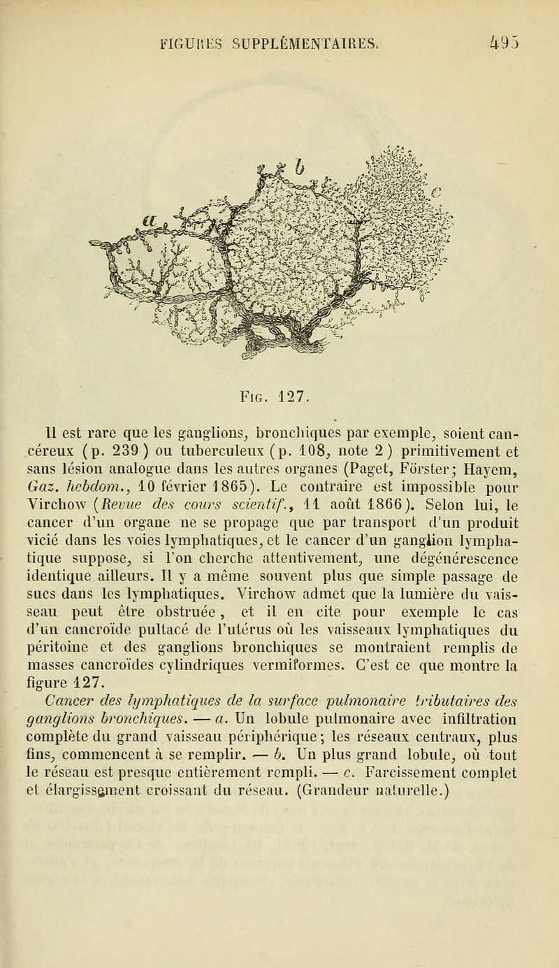 m- FiG. 127. Il est rare que les gang'lioiis_, bronchiques par exemple^ soient can- céreux (p. 239) ou tuberculeux (p. 108, note 2) primitivement et sans lésion analogue dans les autres organes (Paget, Fôrster; Haycm, Gaz. hcbdom., 10 février 1 865). Le contraire est impossible pour Virchow {Revue des cours scientif., 11 août 1866). Selon lui, le cancer d'un organe ne se propage que par transport d'un produit vicié dans les voies lymphatiques, et le cancer d'un gangiion lympha- tique suppose, si l'on cherche attentivement, une dégénérescence identique ailleurs. Il y a même souvent plus que simple passage de sucs dans les lymphatiques. Virchow admet que la lumière du vais- seau peut être obstruée, et il en cite pour exemple le cas d'un cancroïde pultacé de l'utérus où les vaisseaux lymphatiques du péritoine et des ganglions bronchiques se montraient remplis de masses cancroïdes cylindriques vermiforraes. C'est ce que montre la figure 127. Cancer des lymphatiques de la surface pulmonaire tributaires des ganglions bronchiques. — a. Un lobule pulmonaire avec infiltration complète du grand vaisseau périphérique ; les réseaux centraux, plus fins, commencent à se remplir. — b. Un plus grand lobule, où tout le réseau est presque entièrement rempli. — c. Farcissement complet et élargissement croissant du réseau. {Grandeur naturelle.)