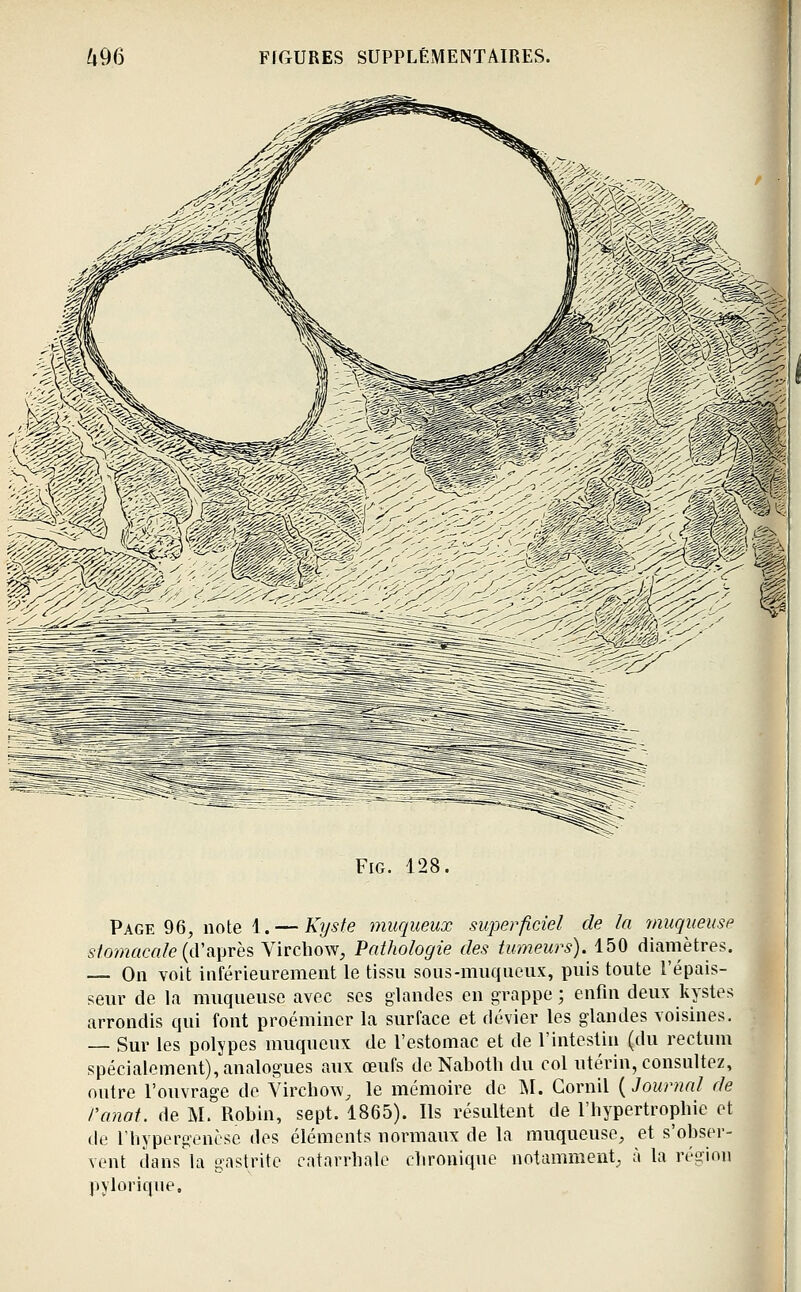 FiG. 128. Page 96, note 1. — Kyste muqueux superficiel de la ynuqueuse sto'macaIe{cVaprès Vircbow, Pathologie des tumeurs). 150 diamètres. — On voit inférieurement le tissu soiis-muqueux, puis toute l'épais- seur de la muqueuse avec ses glandes en grappe ; enfin deux kystes arrondis qui font proéminer la surface et dévier les glandes voisines. — Sur les polypes muqueux de l'estomac et de l'intestin (du rectum spécialement), analogues aux œufs de Naboth du col utérin, consultez, ontre l'ouvrage de Vircho^v^ le mémoire de M. Cornil ( Journal de ranat. de M. Robin, sept. 1865). Ils résultent de l'hypertrophie et de rhypergenése des éléments normaux de la muqueuse, et s'obser- vent dans la gastrite catarrhnle chronique notamment, à la région pylorique.