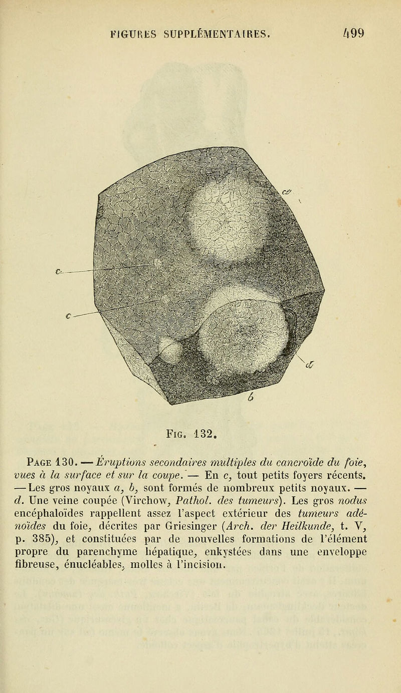 FiG. 132. Page 130. —Éruptions secondaires multiples du cancroïde du foie, vues à la surface et sur la coupe.— En c, tout petits foyers récents. — Les gros noyaux a, b, sont formés de nombreux petits noyaux. — d. Une veine coupée (Virchow, Pathol. des tumeurs). Les gros nodus encéphaloïdes rappellent assez l'aspect extérieur des tumeurs adé- 7WÏdes du foie, décrites par Griesinger (Arch. der Heilkunde, t. V, p. 385), et constituées par de nouvelles formations de l'élément propre du parenchyme hépatique, enkystées dans une enveloppe fibreuse, énucléables, molles à l'incision.