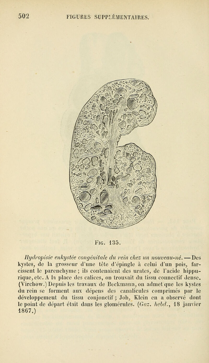 FiG. 135, Hydropisie enkystée congénitale du rein chez un nouveau-né. —Des kystes, de la grosseur d'une tête d'épingle à celui d'un poiS;, far- cissent le parenchyme ; ils contenaient des urates, de l'acide hippu- rique^ etc. A la place des calices, on trouvait du tissu connectif dense. (Virchow.) Depuis les travaux de Beckmann, on admet que les kystes du rein se forment aux dépens des canalicules comprimés par le développement du tissu conjonctif ; Joh, Klein en a observé dont le point de départ était dans les glomérules. {Gaz. hebd., 18 janvier 1867.)