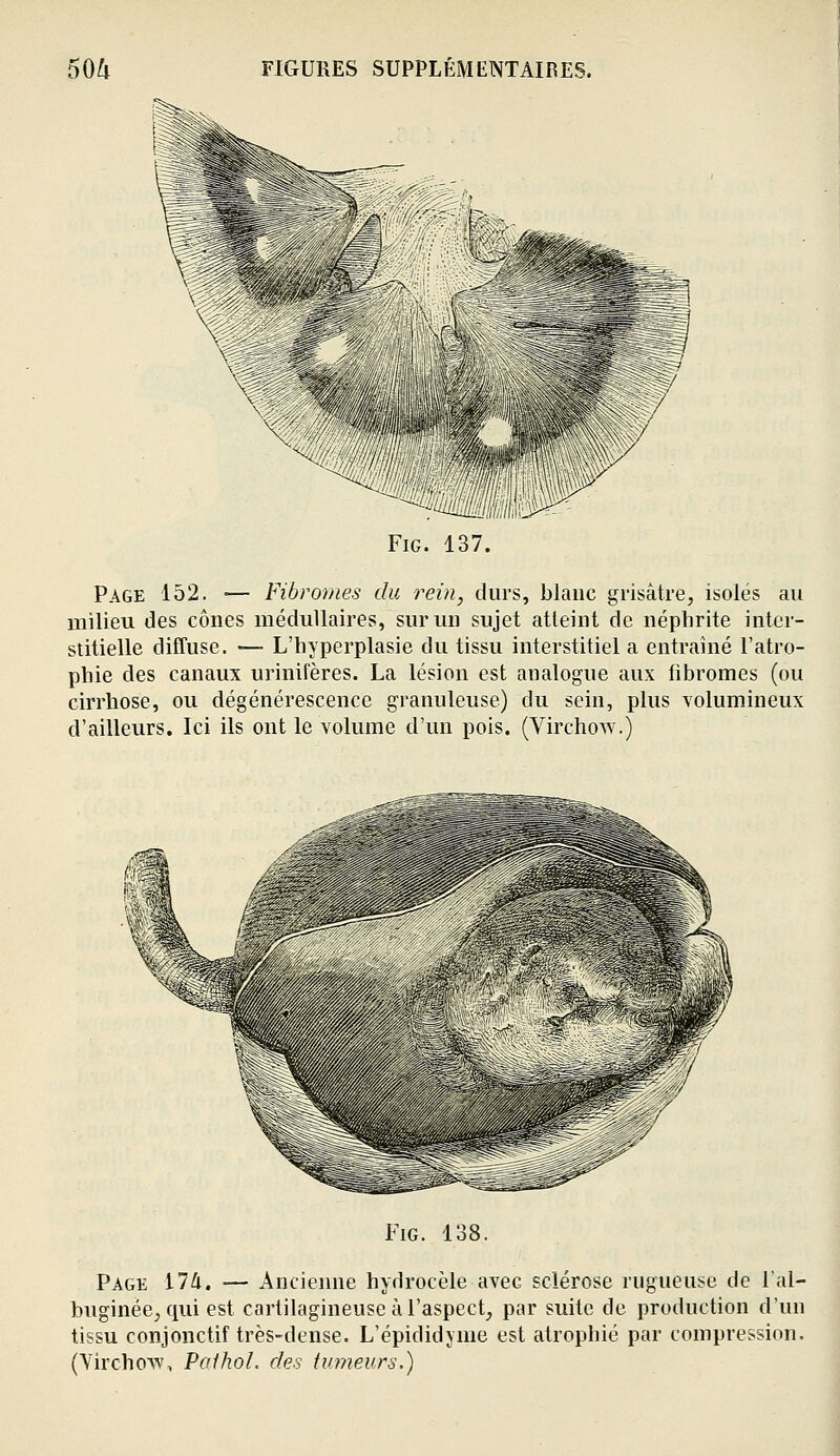 FiG. 137. Page 152. — Fibromes du rein, durs, blanc grisâtre, isolés au milieu des cônes médullaires, sur un sujet atteint de néphrite inter- stitielle diffuse. —• L'hyperplasie du tissu interstitiel a entraîné l'atro- phie des canaux urinifères. La lésion est analogue aux fibromes (ou cirrhose, ou dégénérescence granuleuse) du sein, plus volumineux d'ailleurs. Ici ils ont le volume d'un pois. (Virchow.) FiG. 138. Page il h. — Ancienne hydrocèle avec sclérose rugueuse de l'al- buginée^ qui est cartilagineuse à l'aspect, par suite de production d'un tissu conjonctif très-dense. L'épididjme est atrophié par compression. (Vircho\v, Paihol. des tumeurs.)